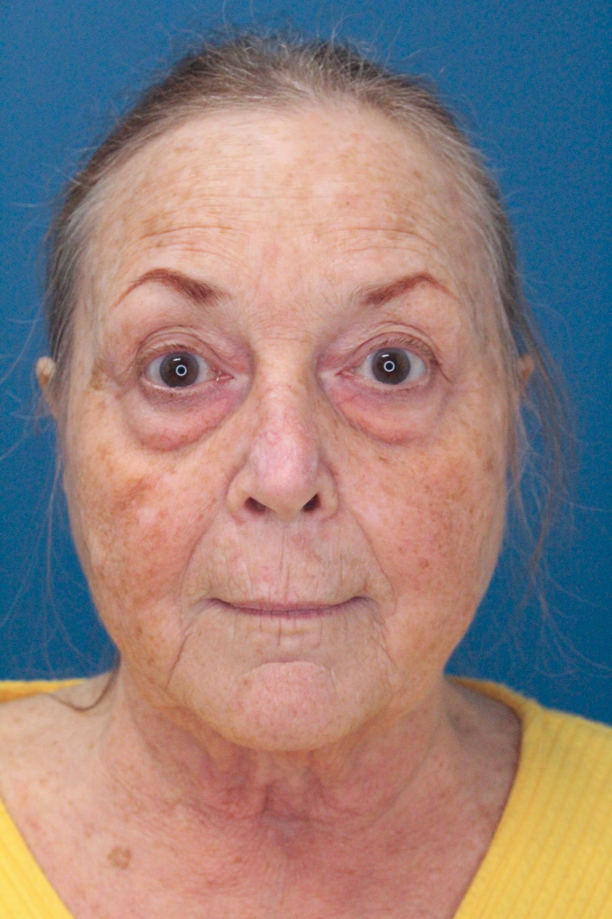 Lower Blepharoplasty