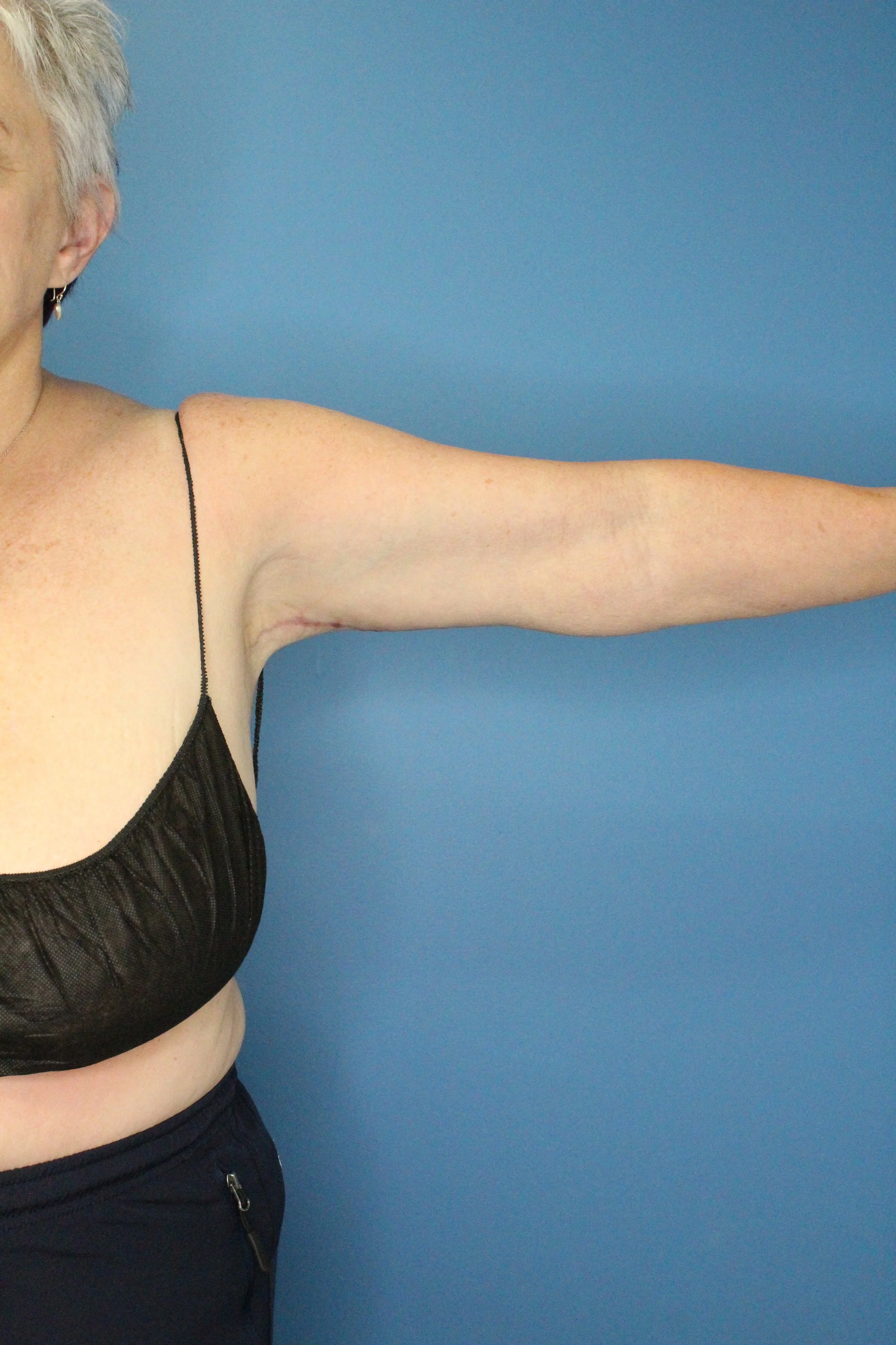 Arm Lift