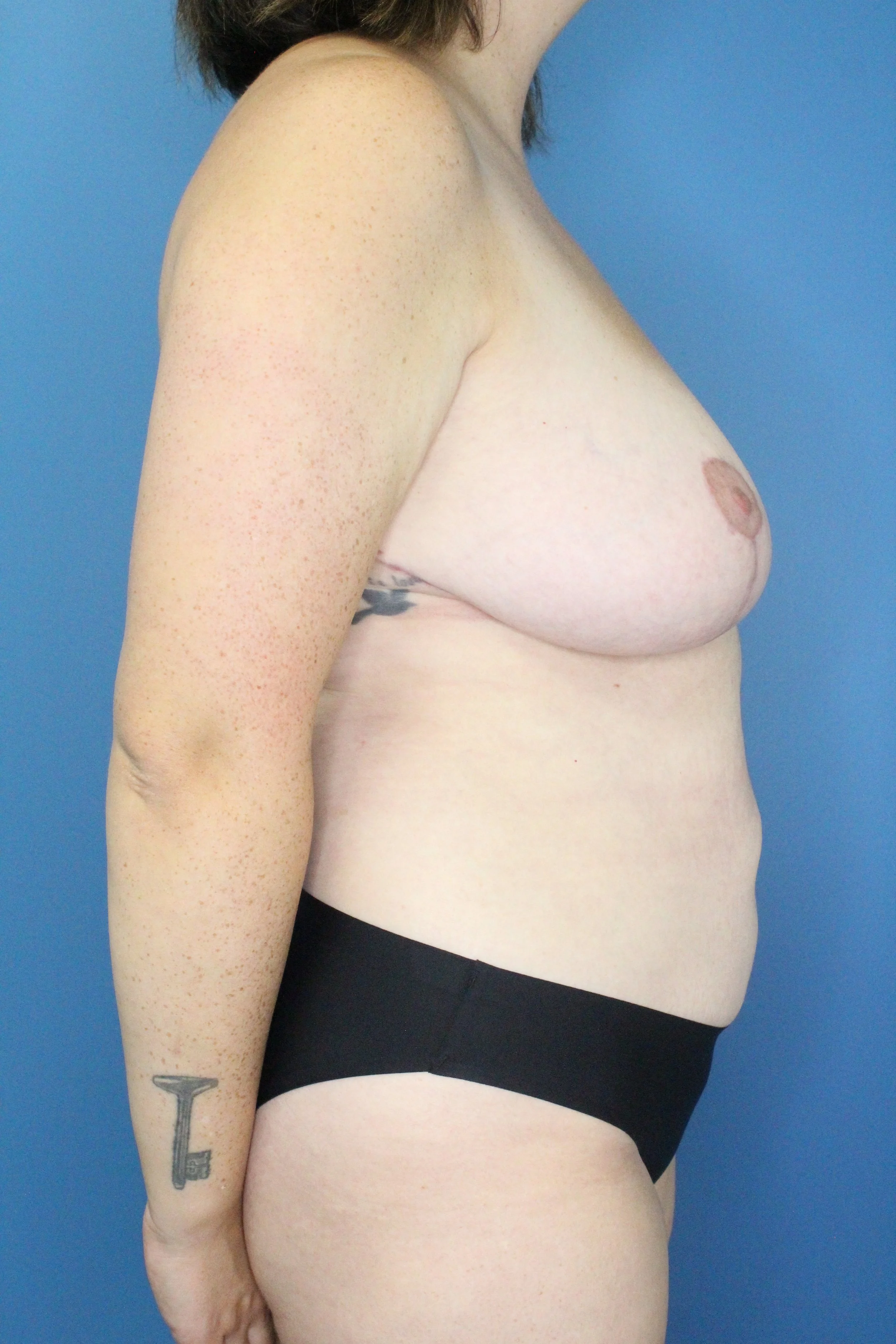 Breast Reduction