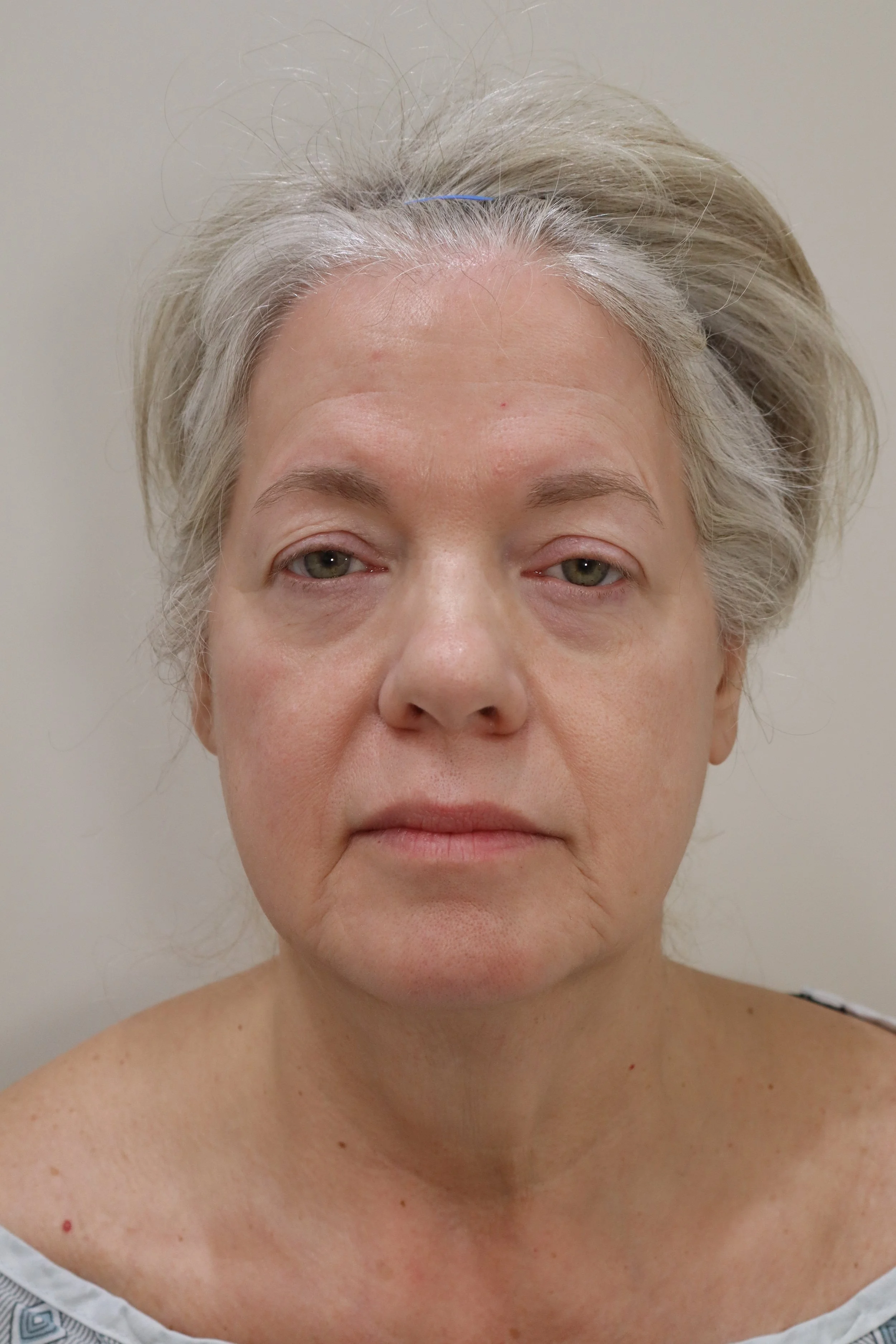 Deep Plane Face and Neck Lift 