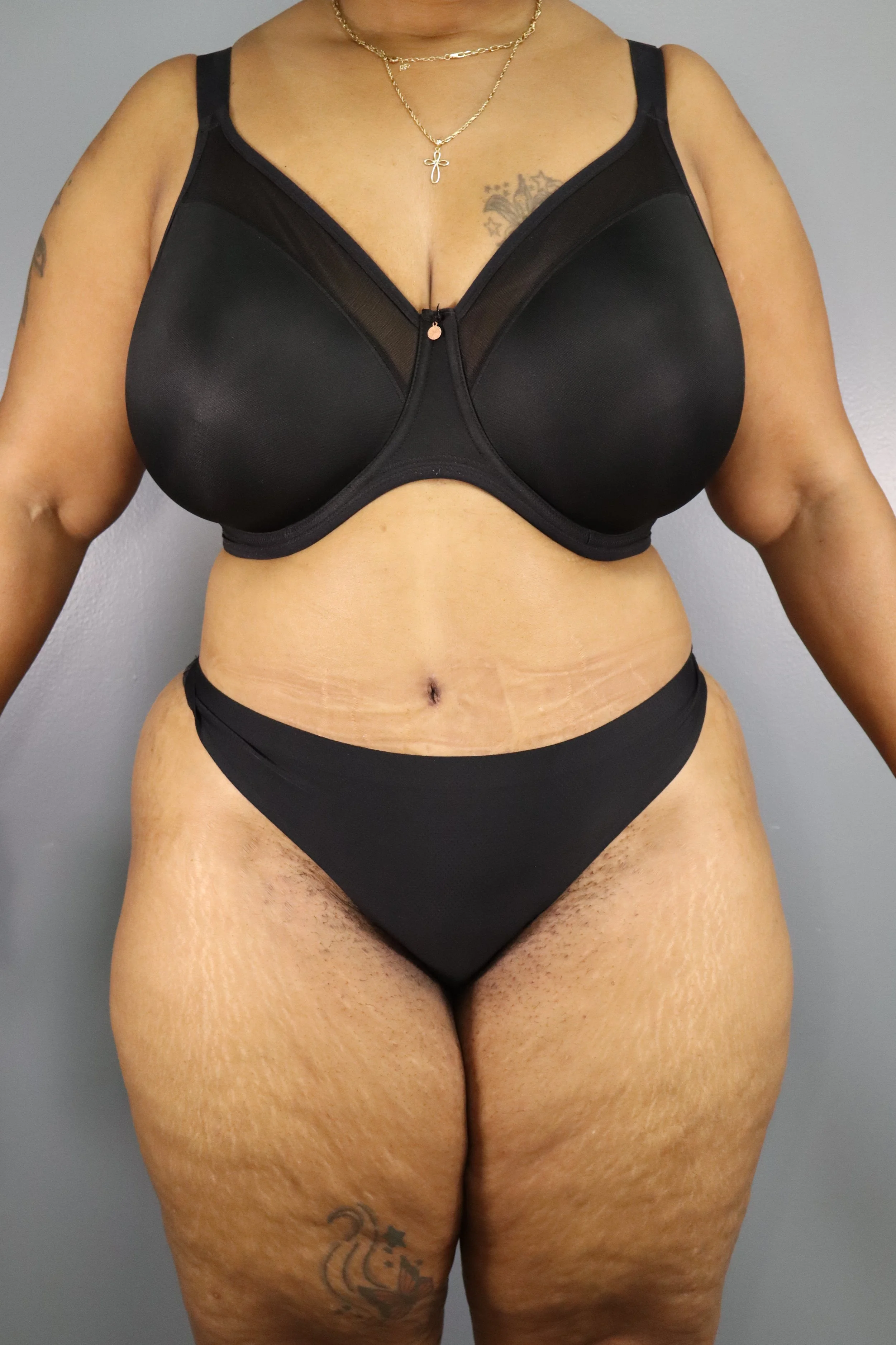 Abdominoplasty 