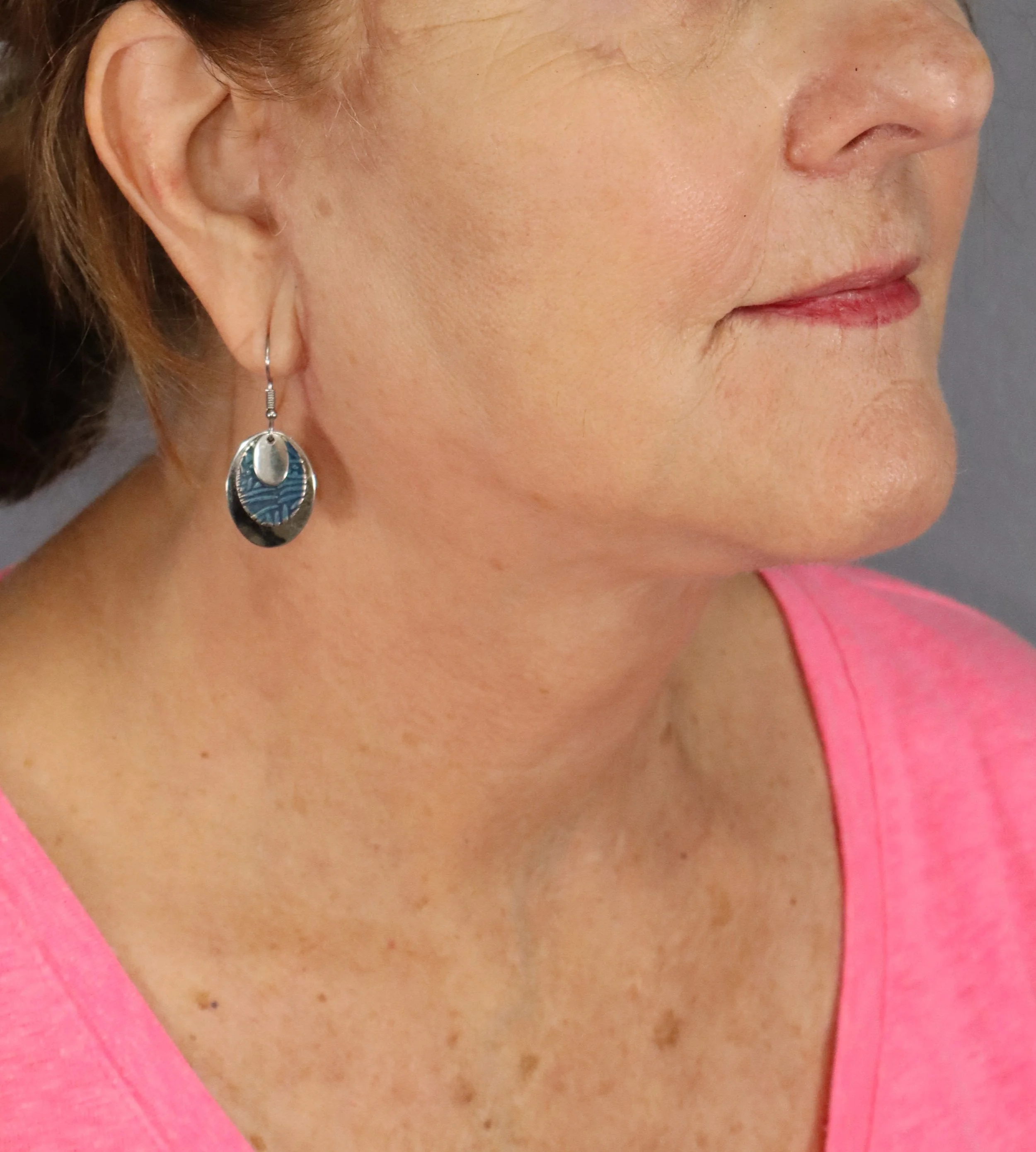 Deep Plane Face and Neck Lift 
