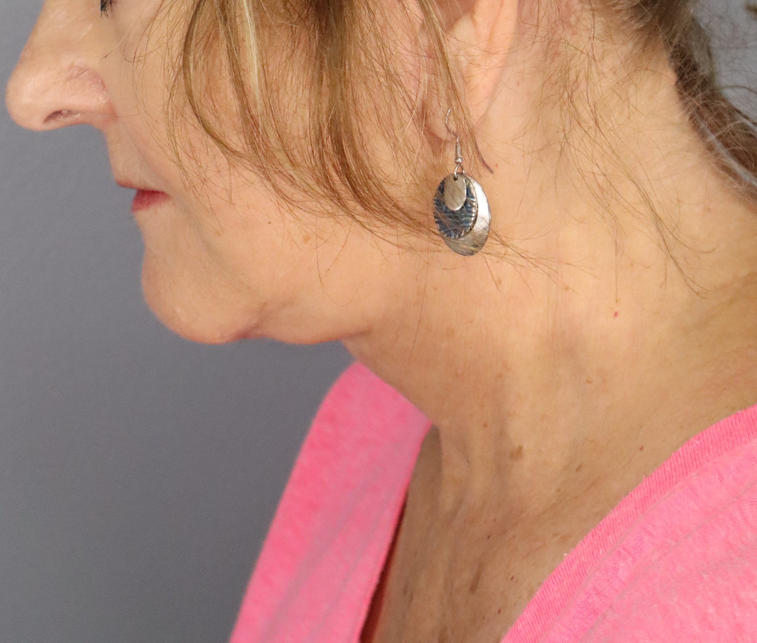 Deep Plane Face and Neck Lift 