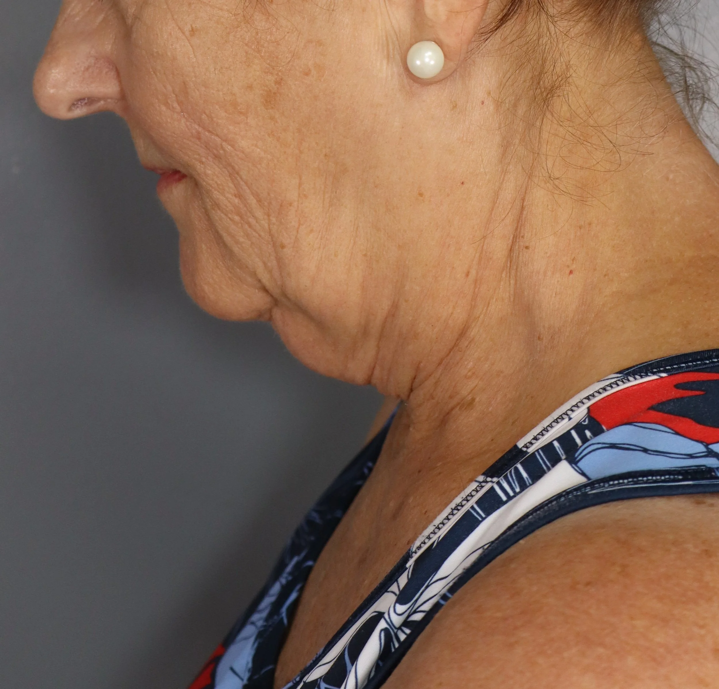 Deep Plane Face and Neck Lift 