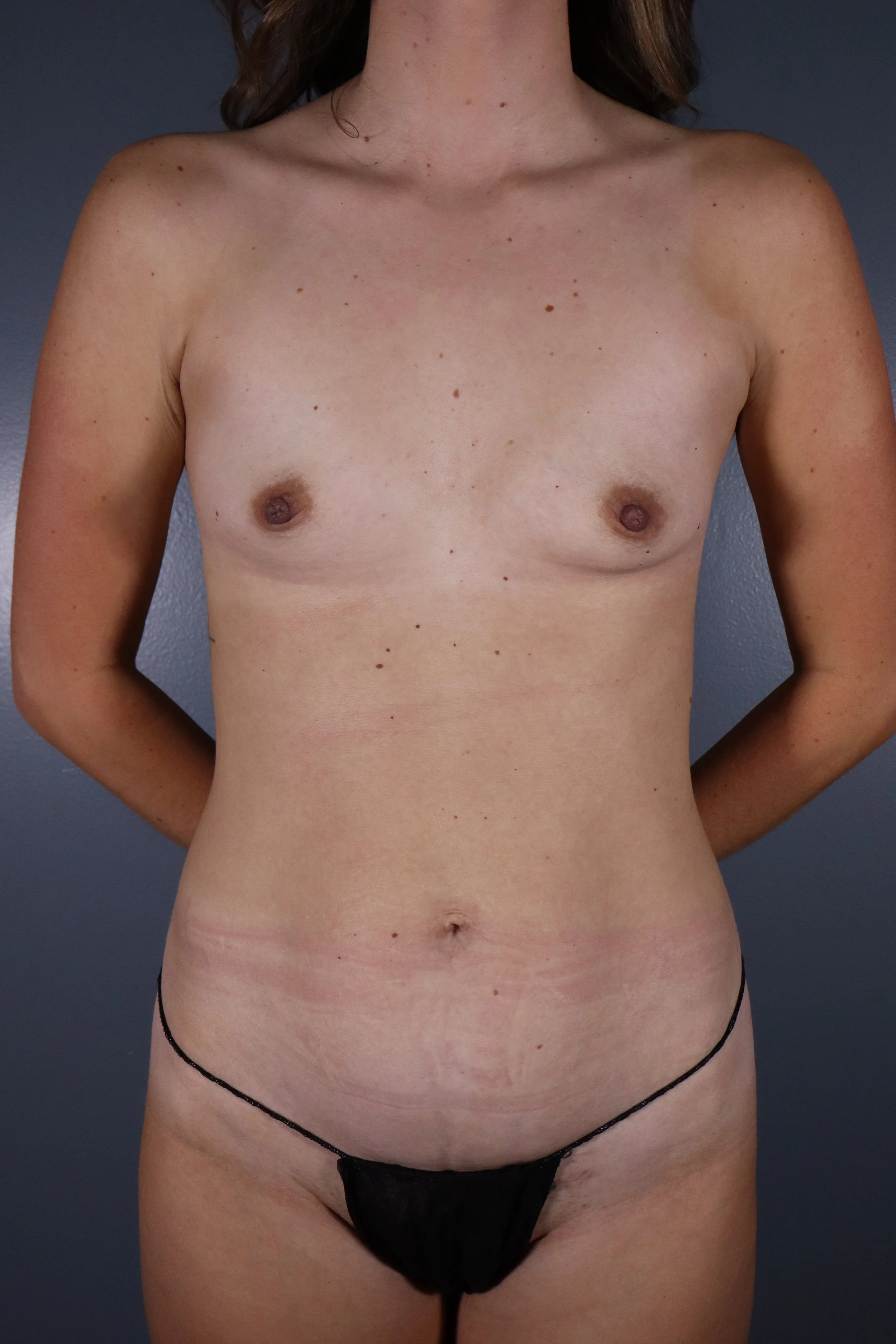 Breast Augmentation 