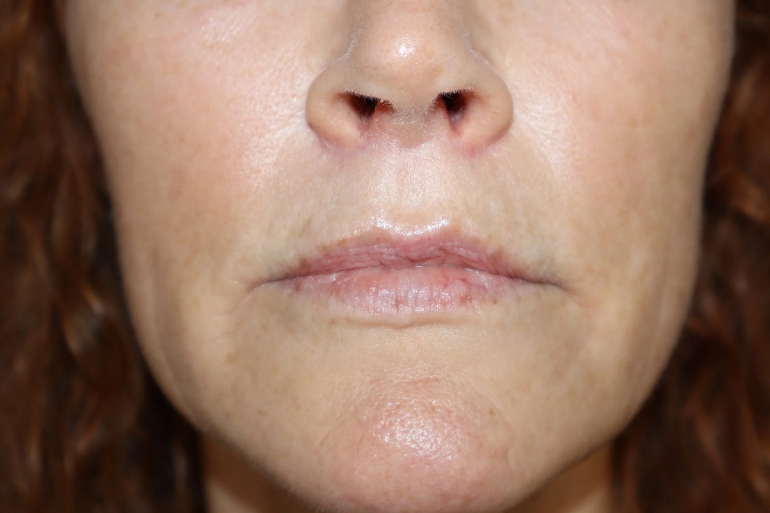 Lip Lift 