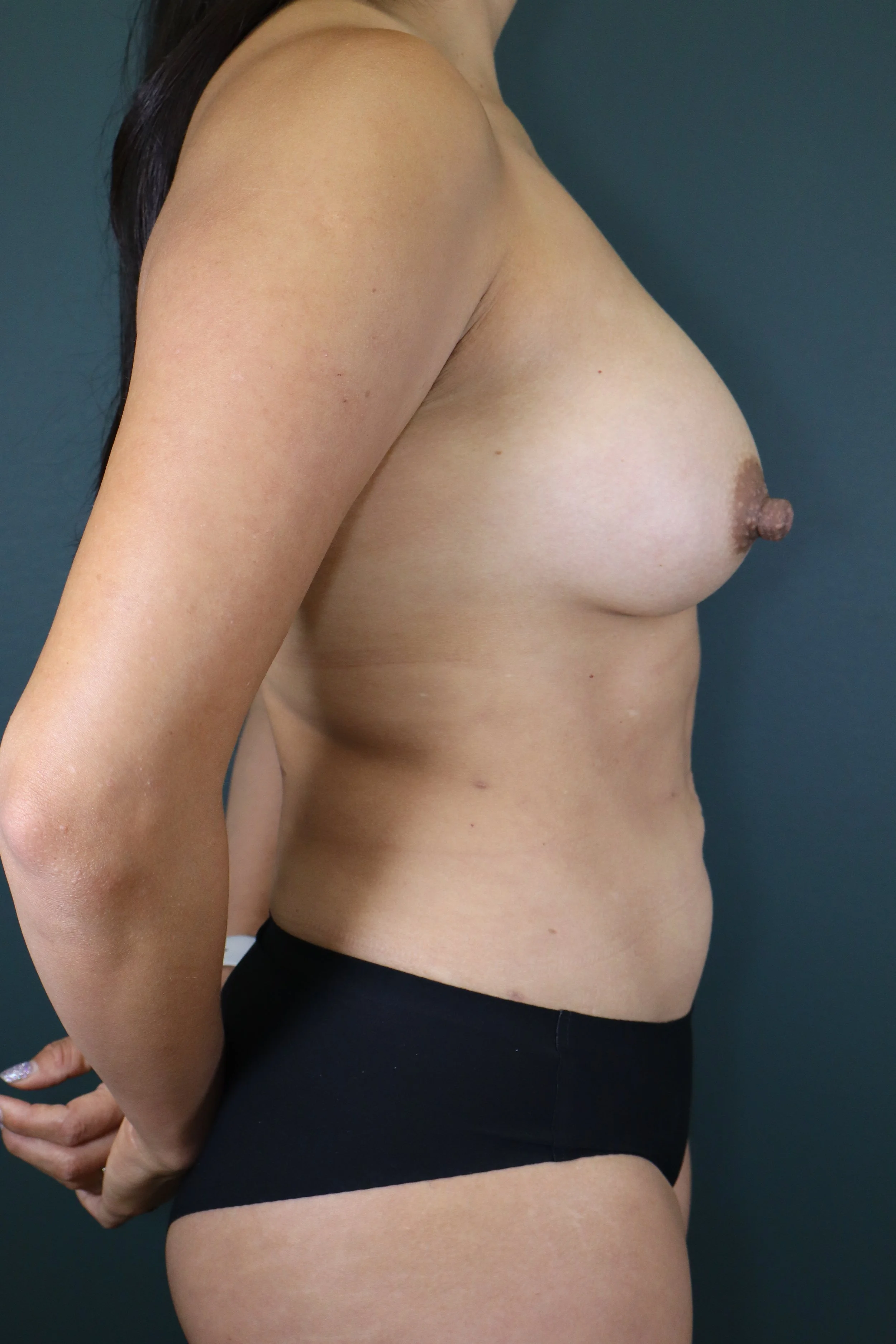 Breast Augmentation 