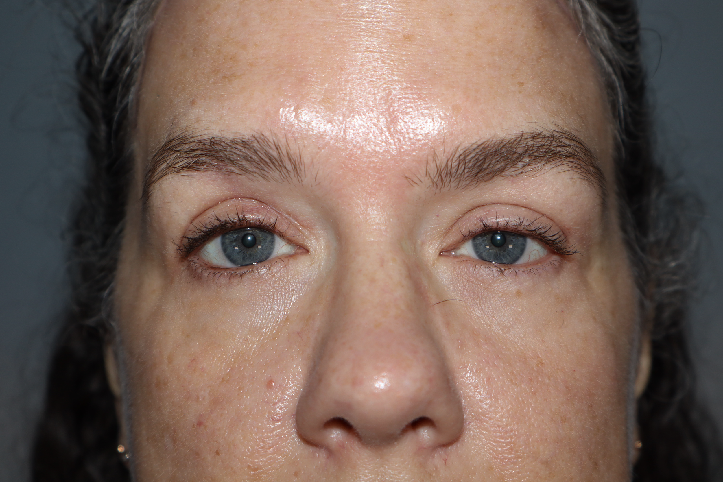 Blepharoplasty and Brow Lift 