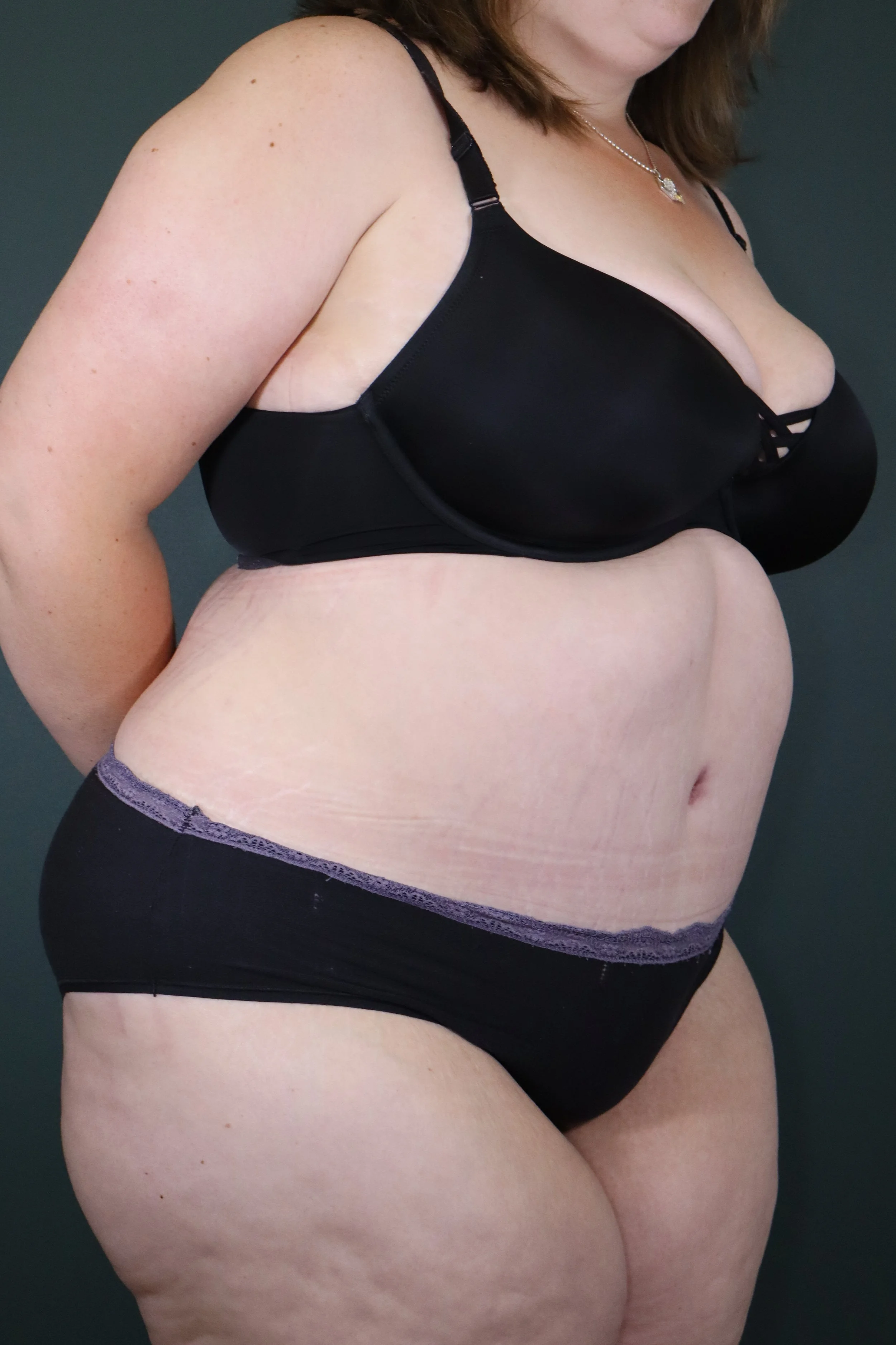 Abdominoplasty 