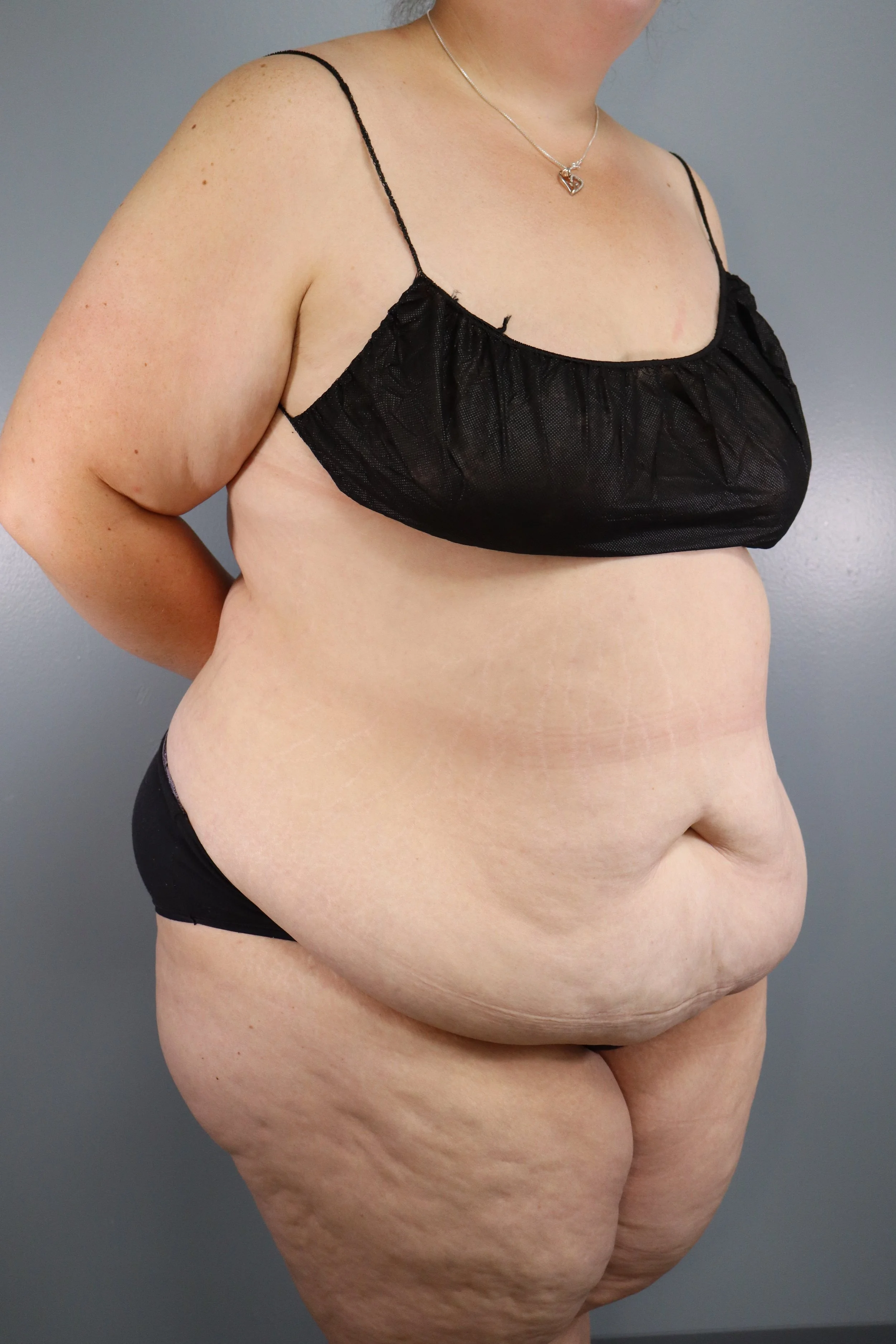Abdominoplasty 