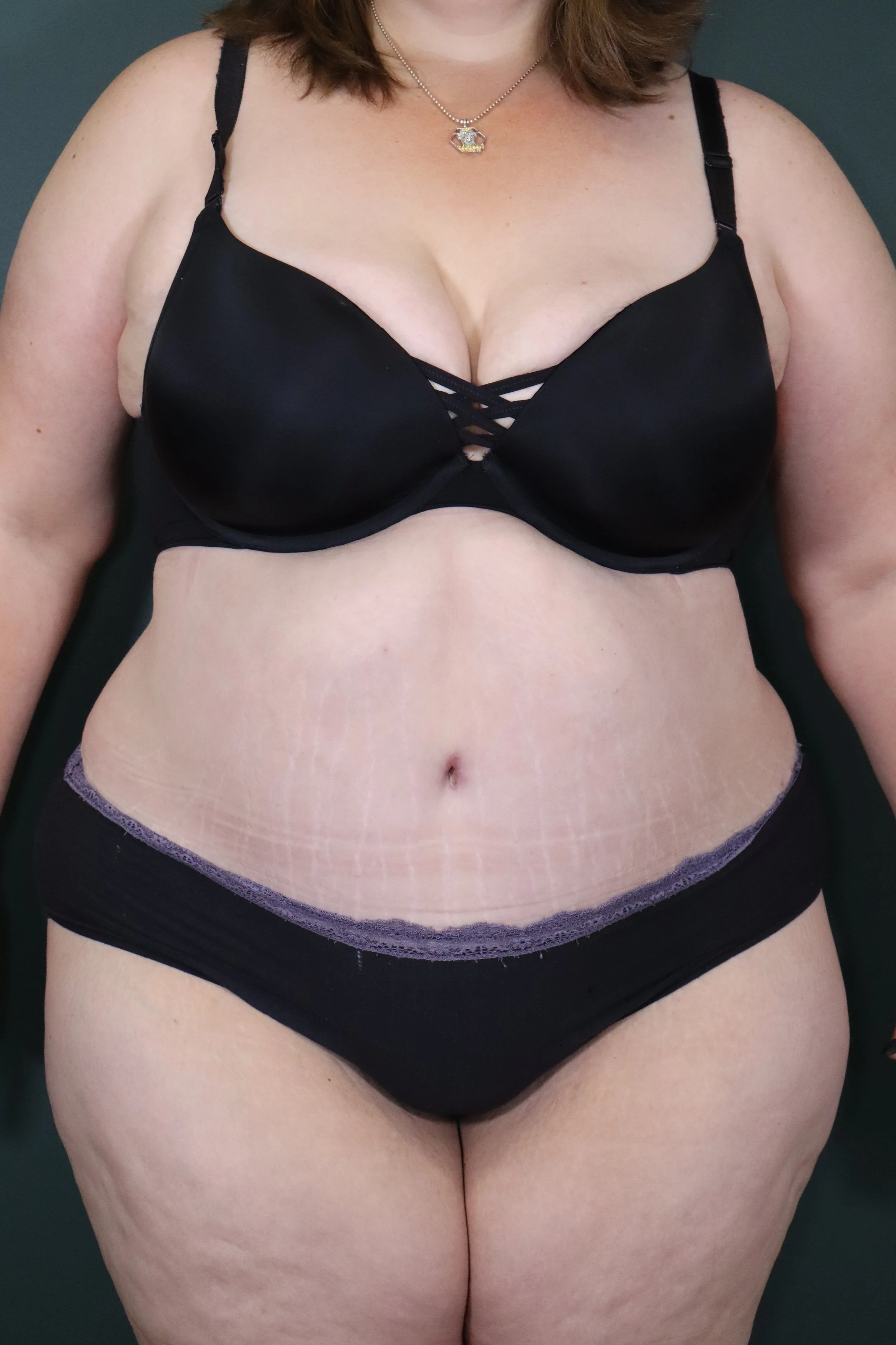 Abdominoplasty 