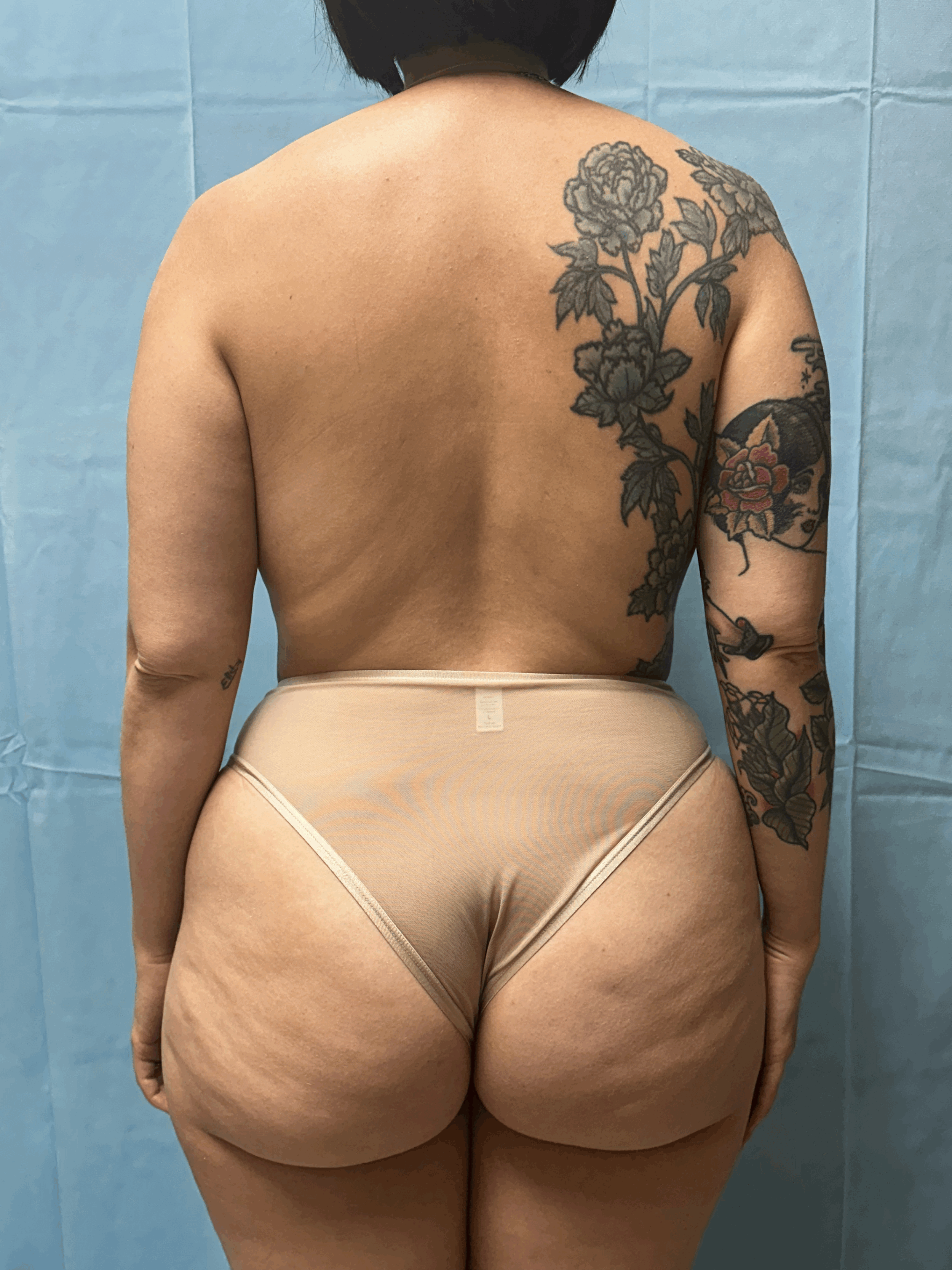 Abdominal Liposuction