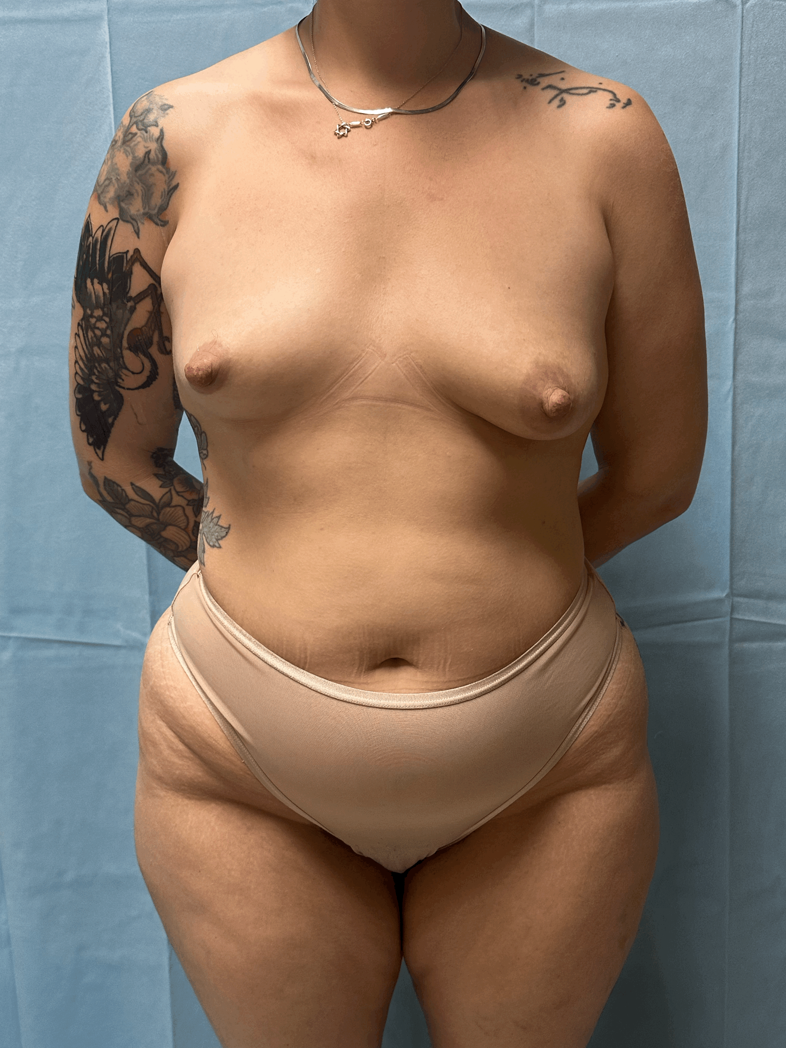 Abdominal Liposuction