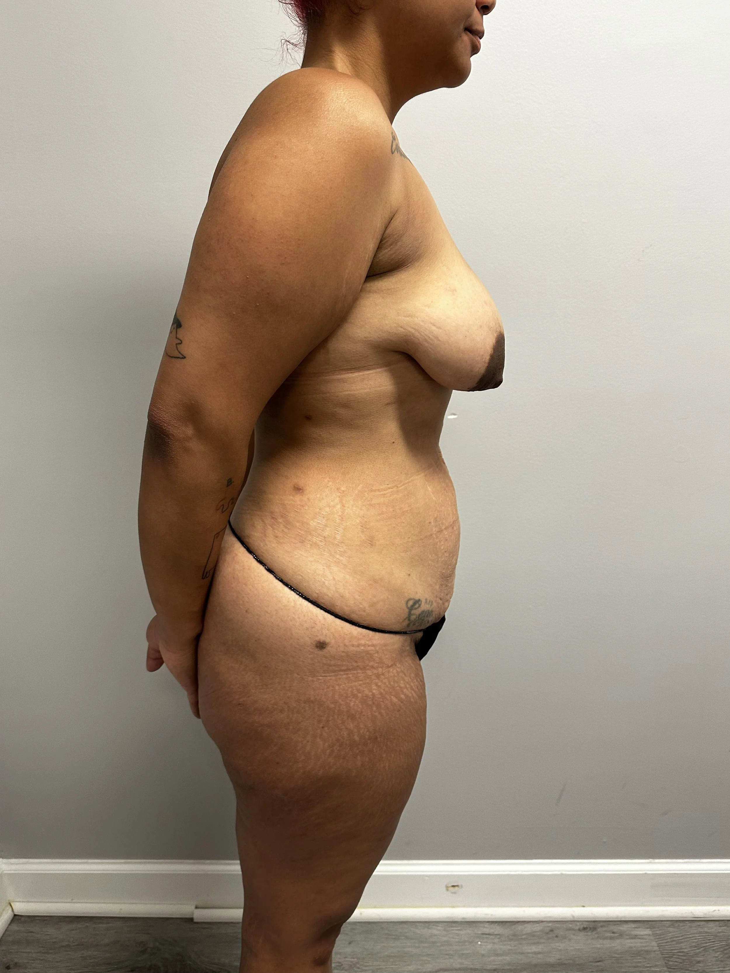 Abdominoplasty 