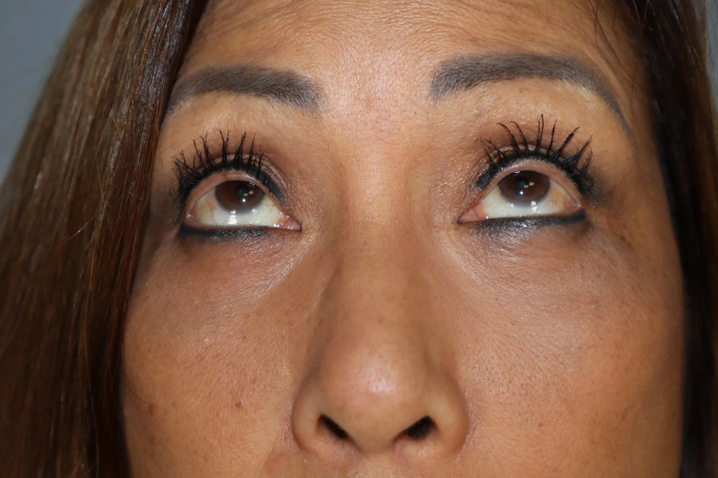 Lower Blepharoplasty 