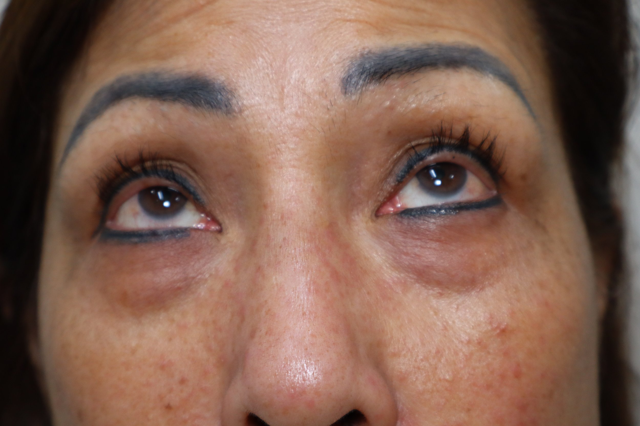 Lower Blepharoplasty 