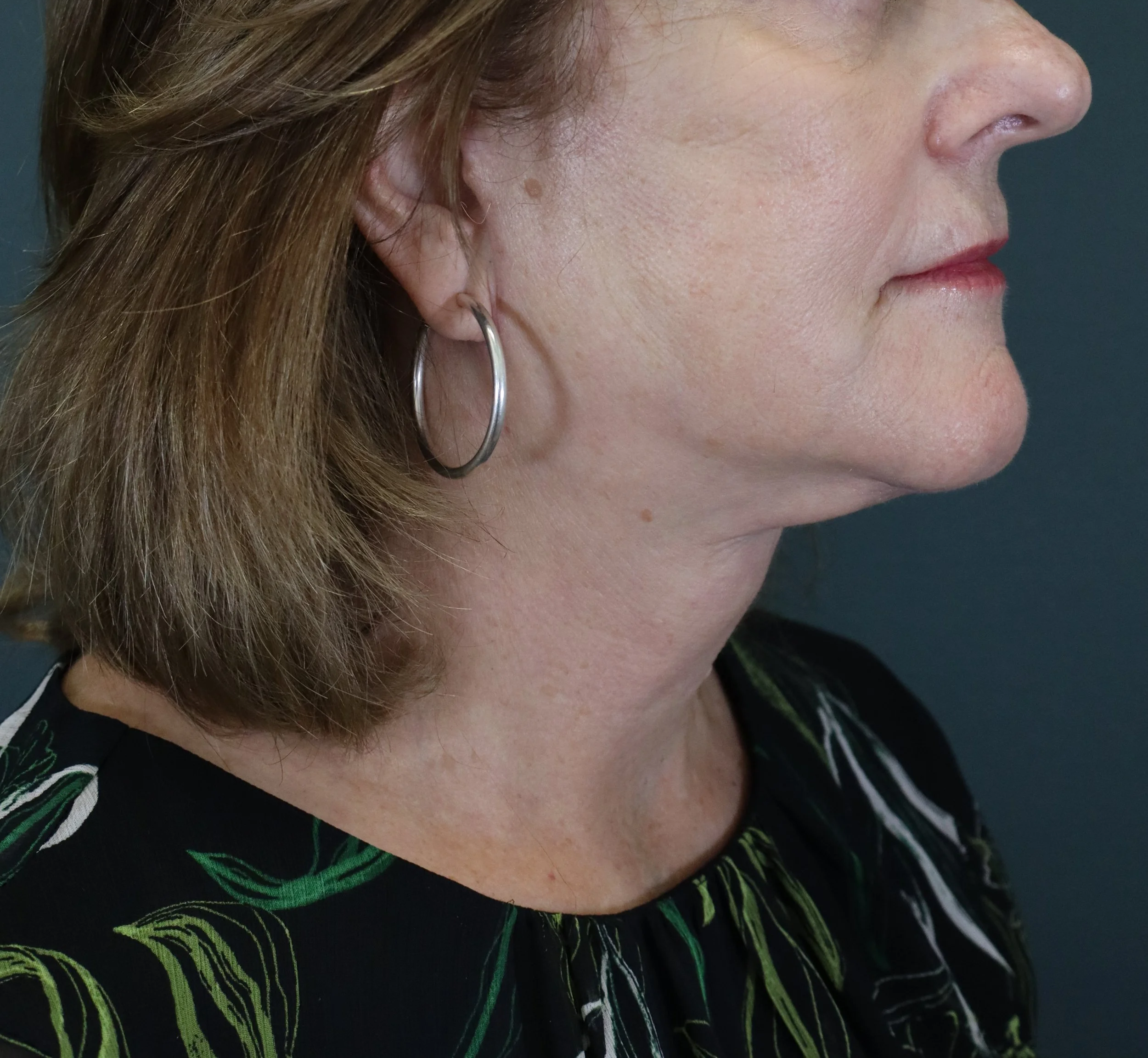Deep Plane Face and Neck Lift 
