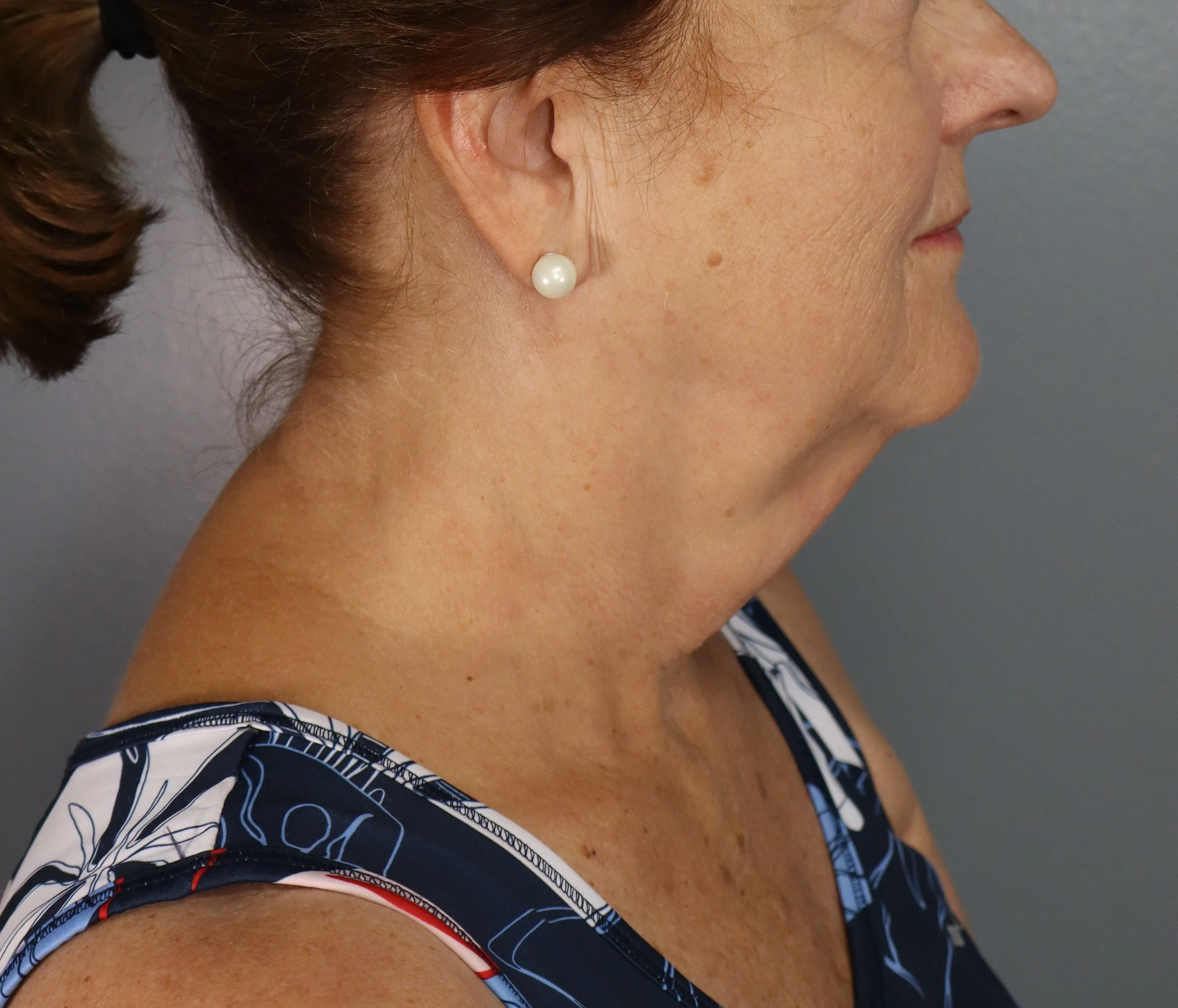 Deep Plane Face and Neck Lift 