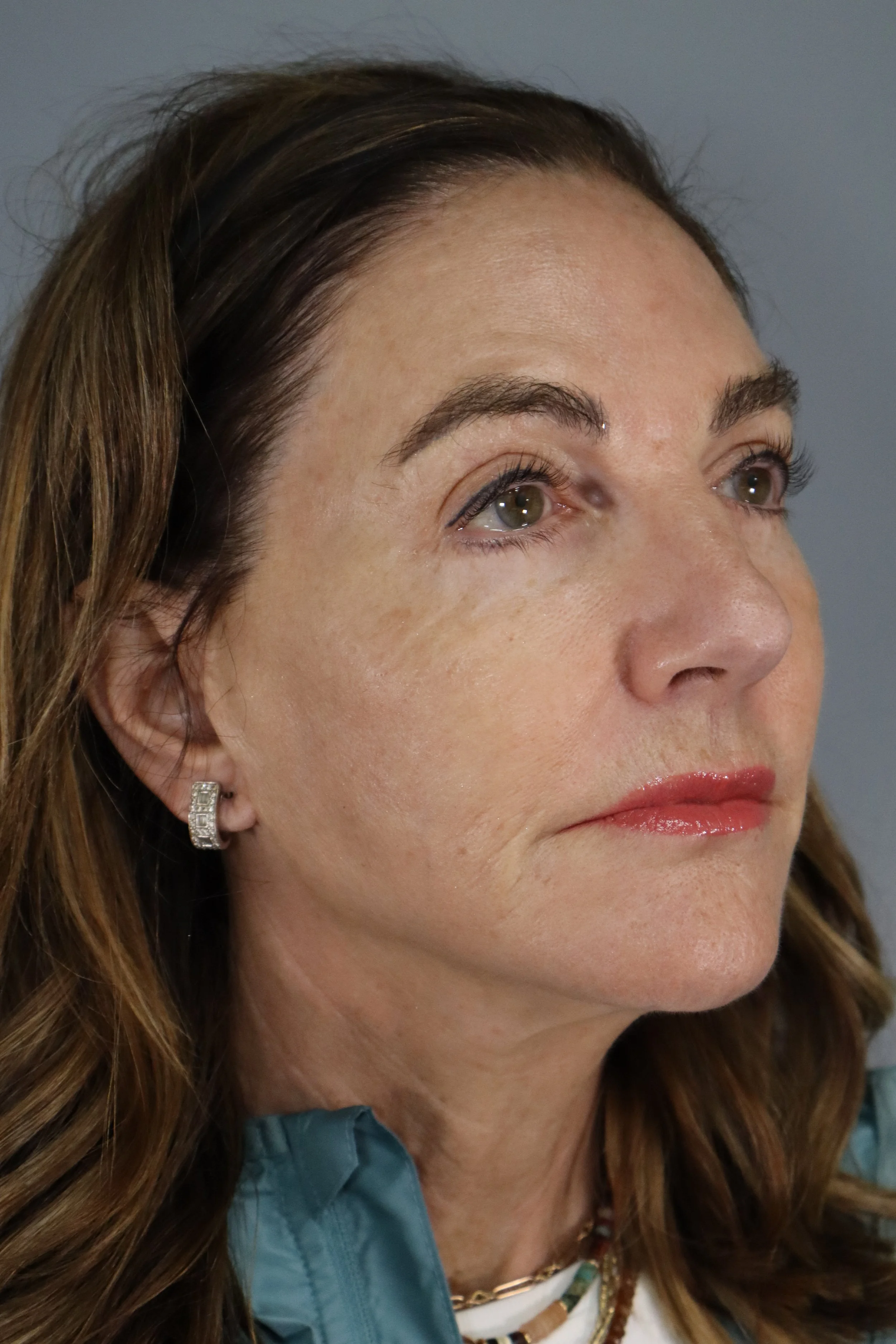 Face and Neck Lift, Temporal Brow Lift 