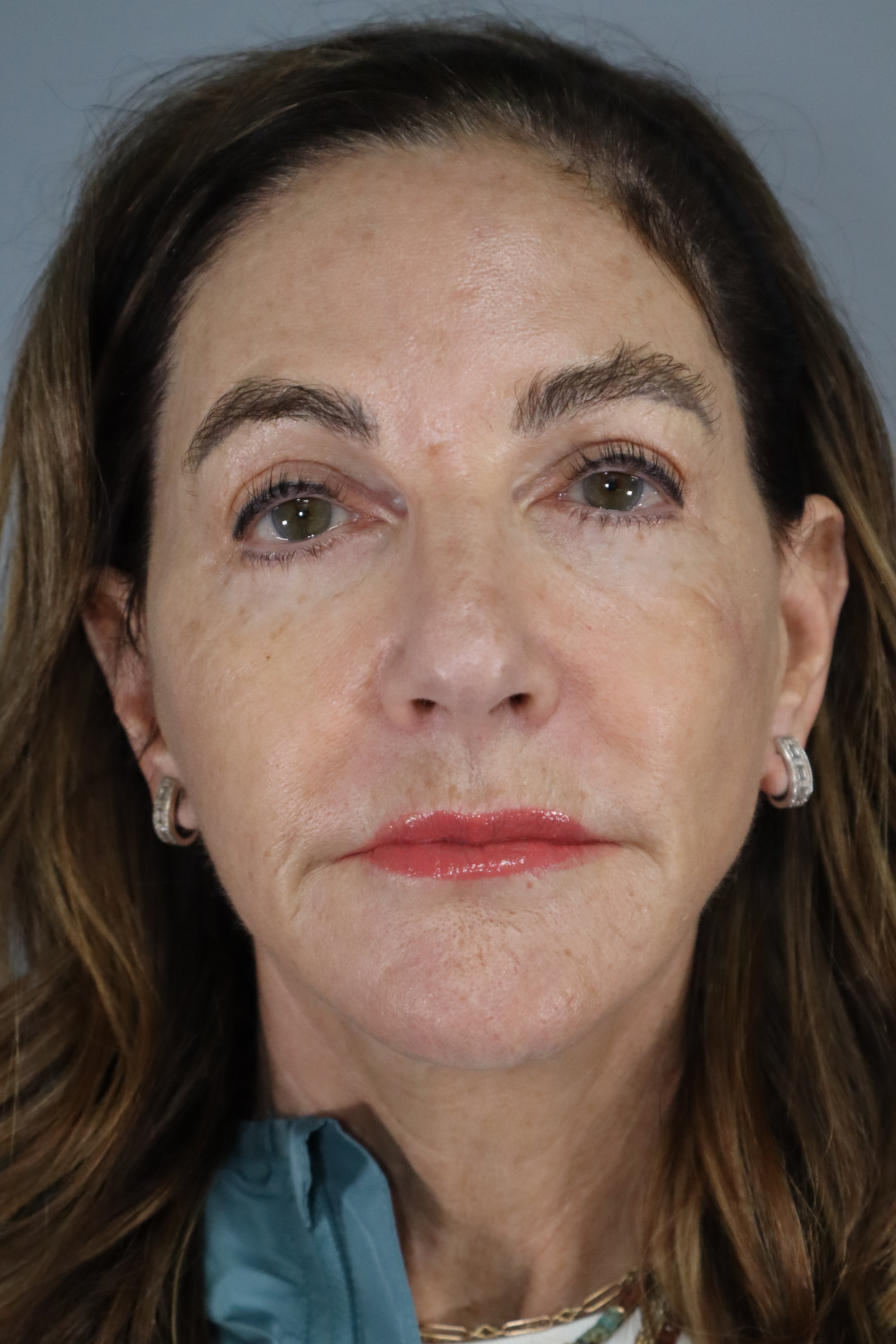 Face and Neck Lift, Temporal Brow Lift 