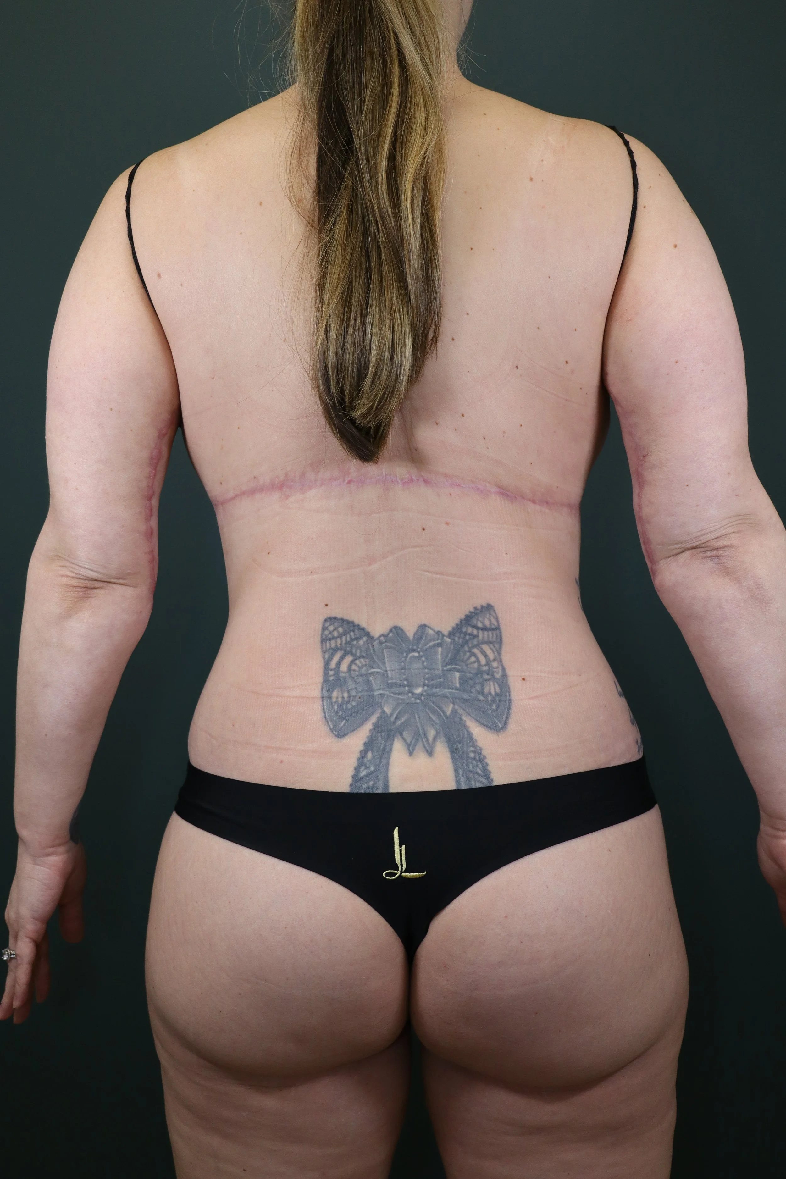 Bra line Back lift, Posterior lower body lift &amp; BBL