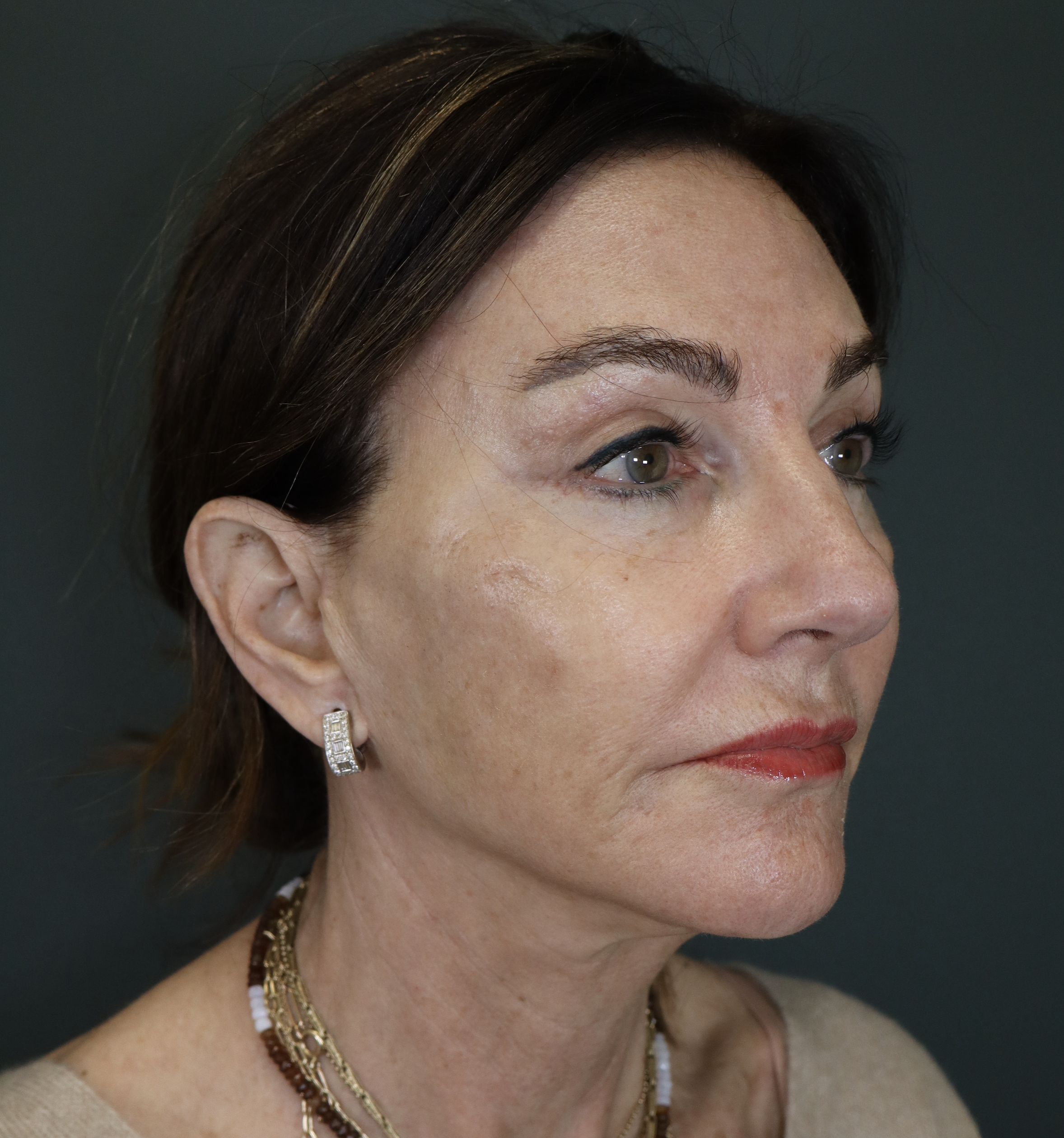 Face and Neck Lift, Temporal Brow Lift
