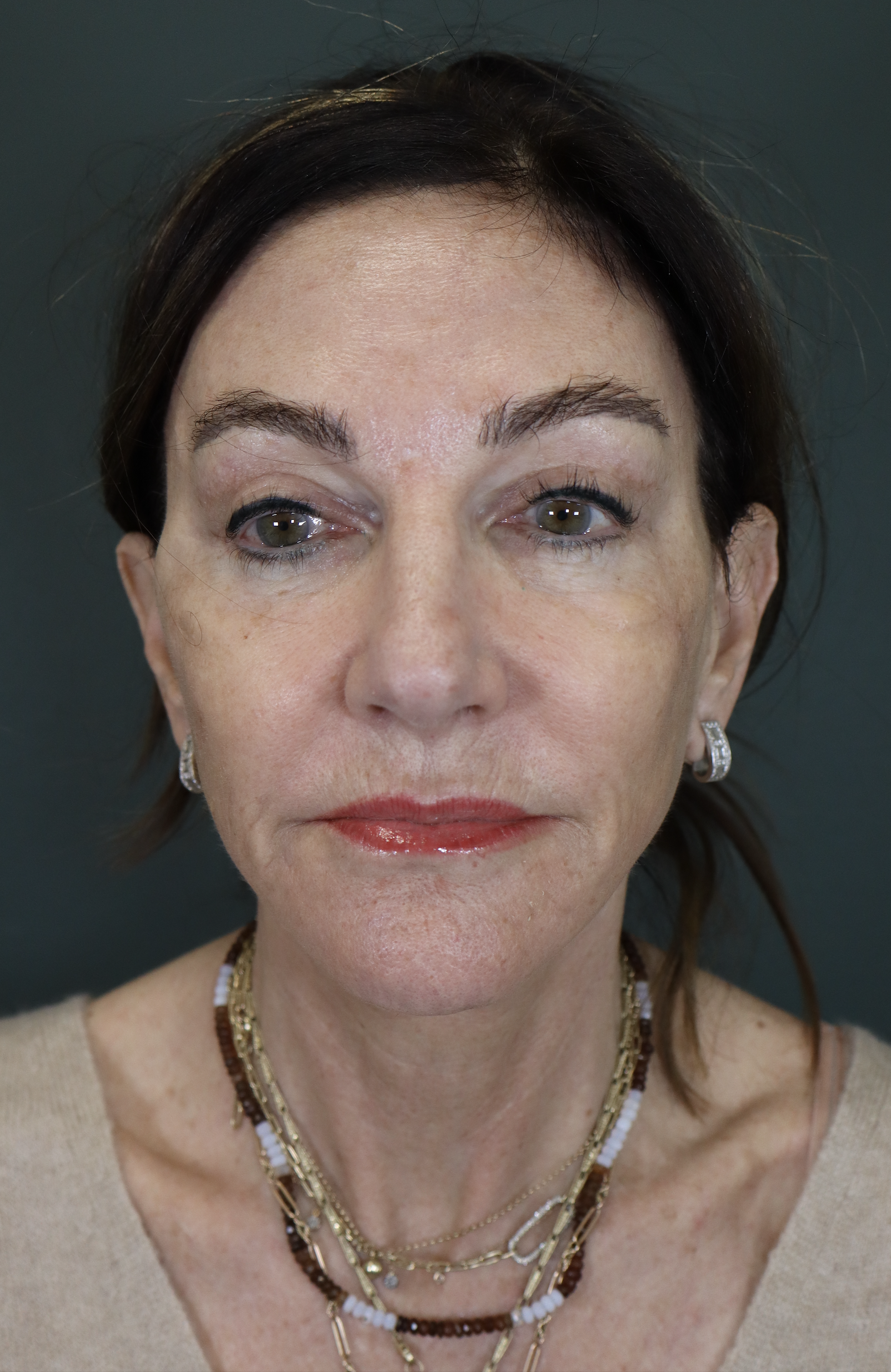 Face and Neck Lift, Temporal Brow Lift 