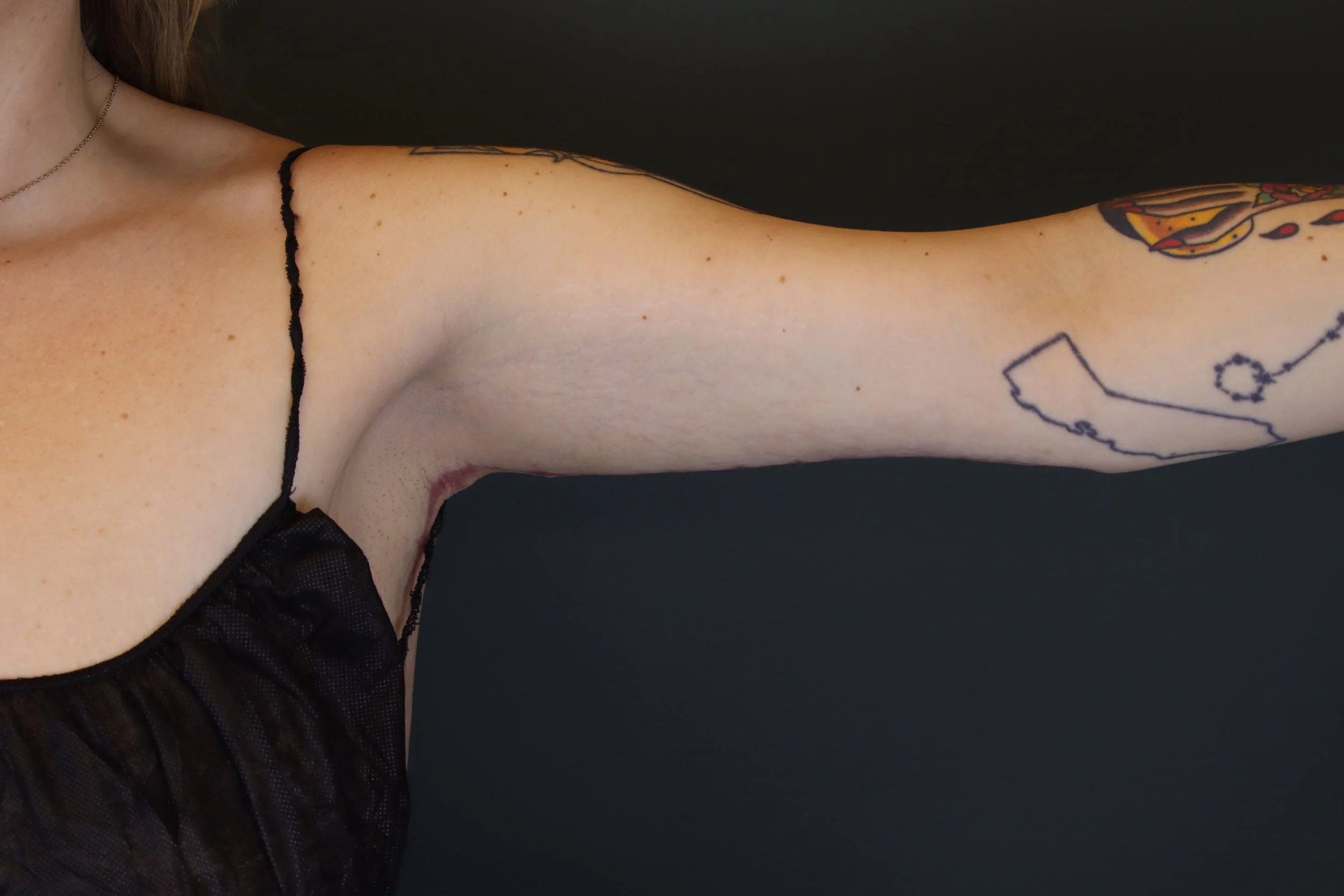 Brachioplasty 