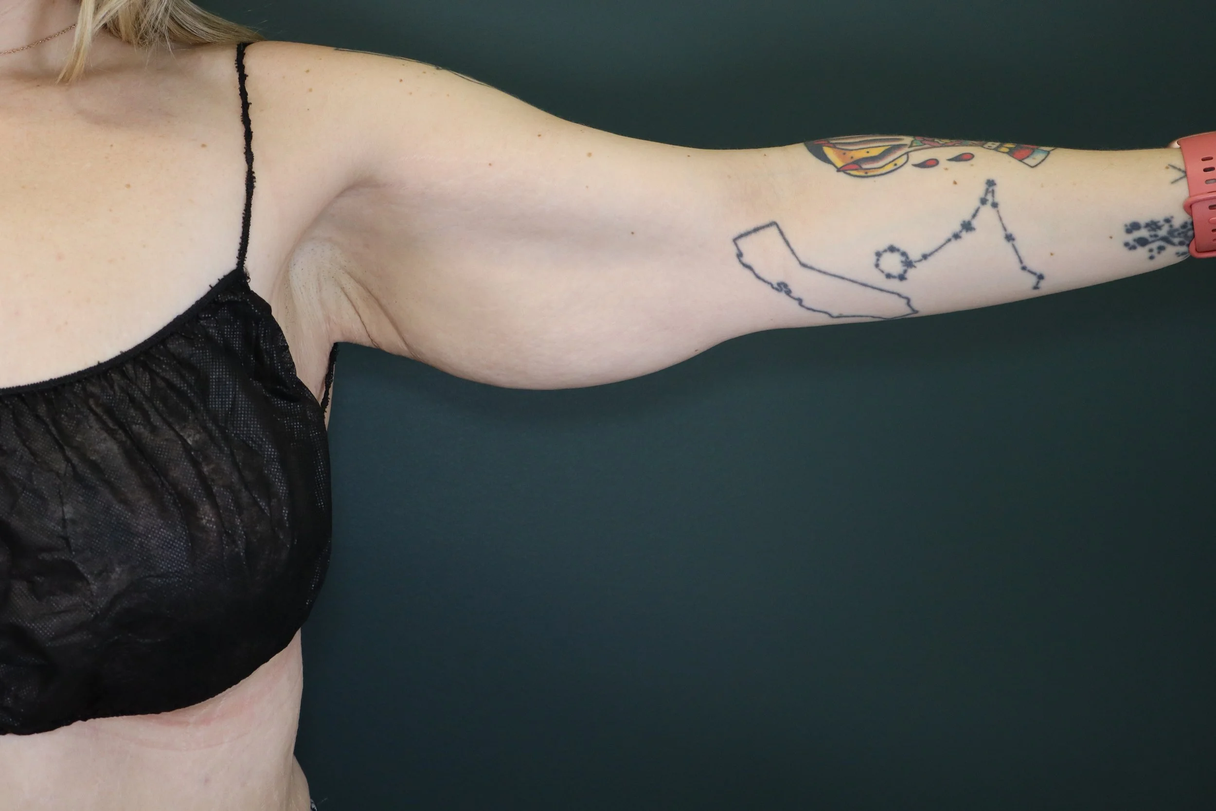 Brachioplasty 