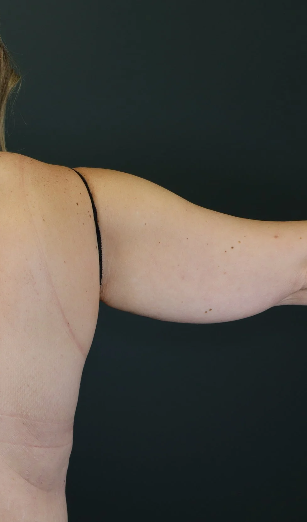 Brachioplasty 