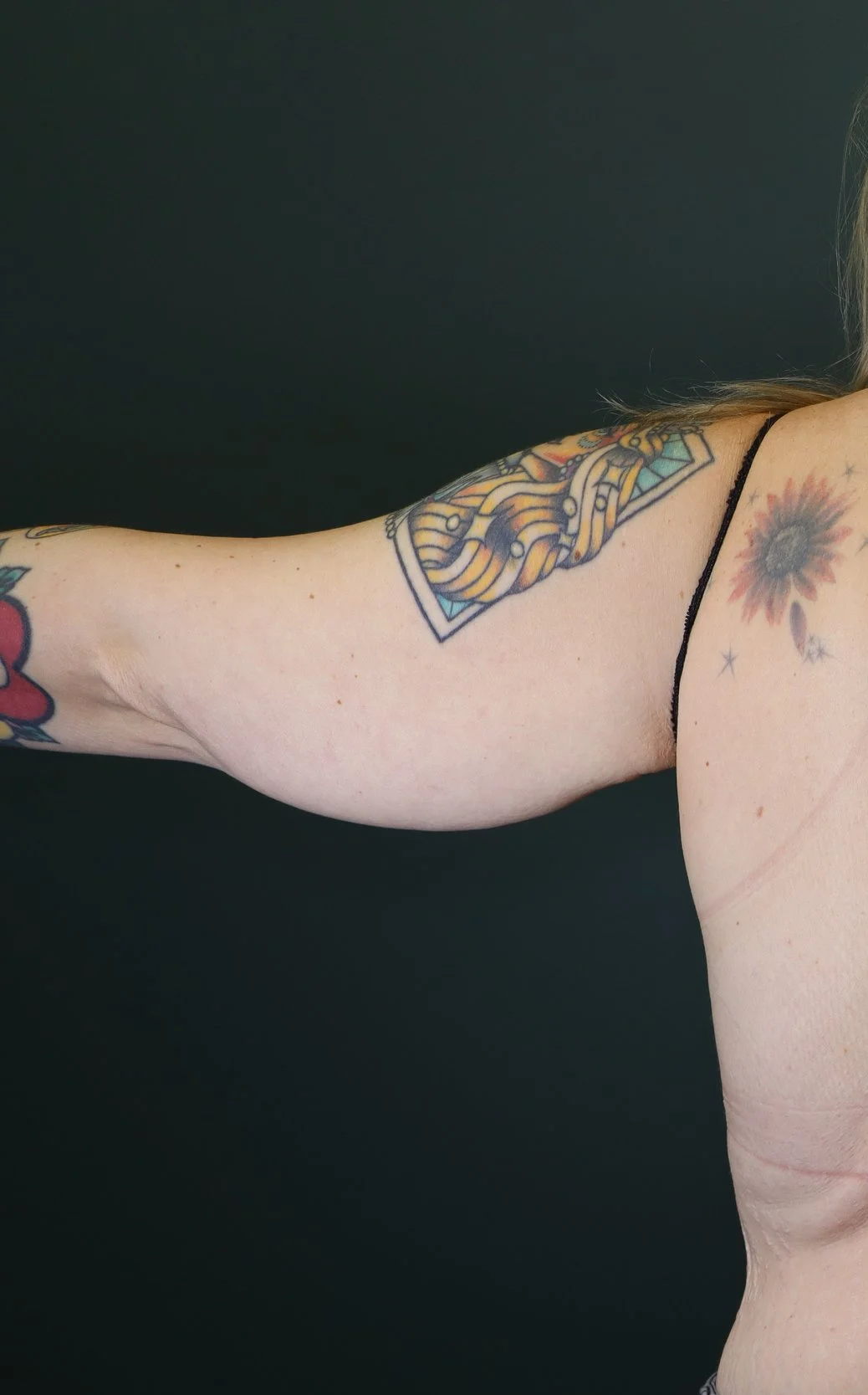 Brachioplasty 