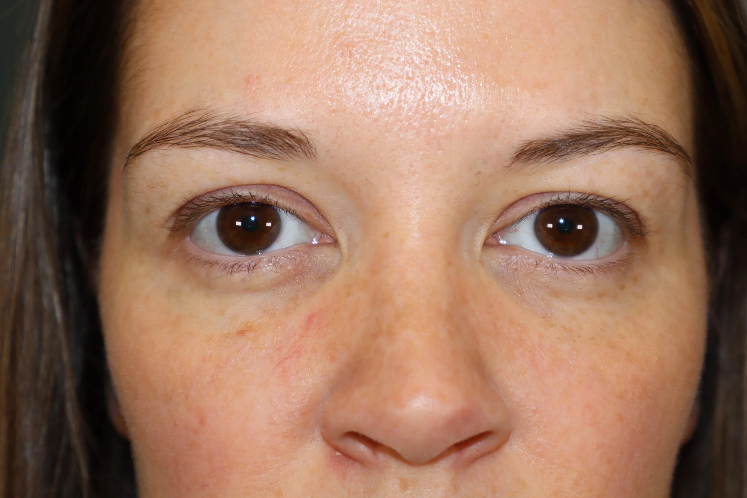 Upper Blepharoplasty 