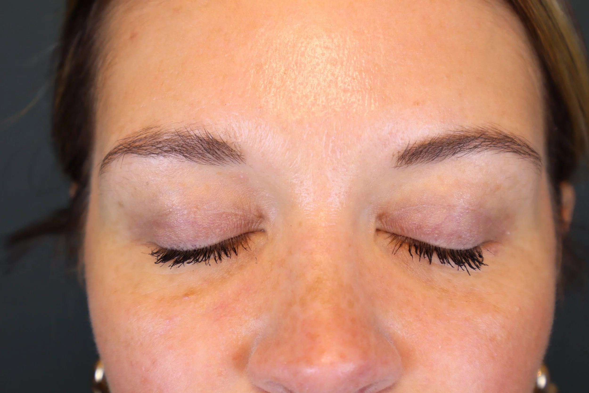 Upper Blepharoplasty 