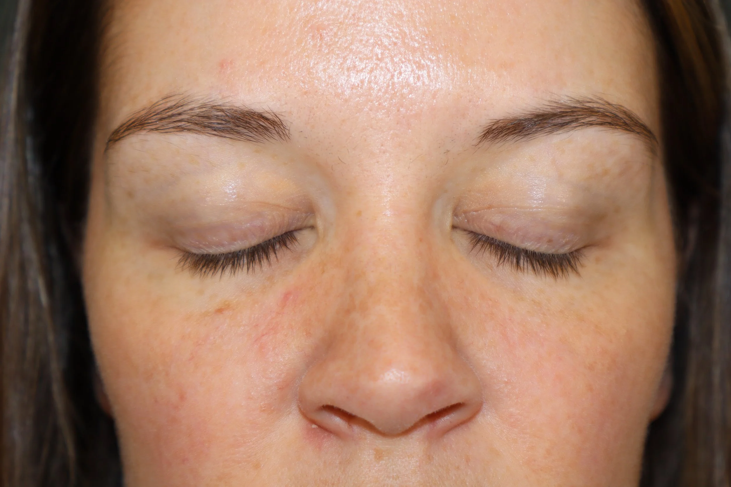 Upper Blepharoplasty 