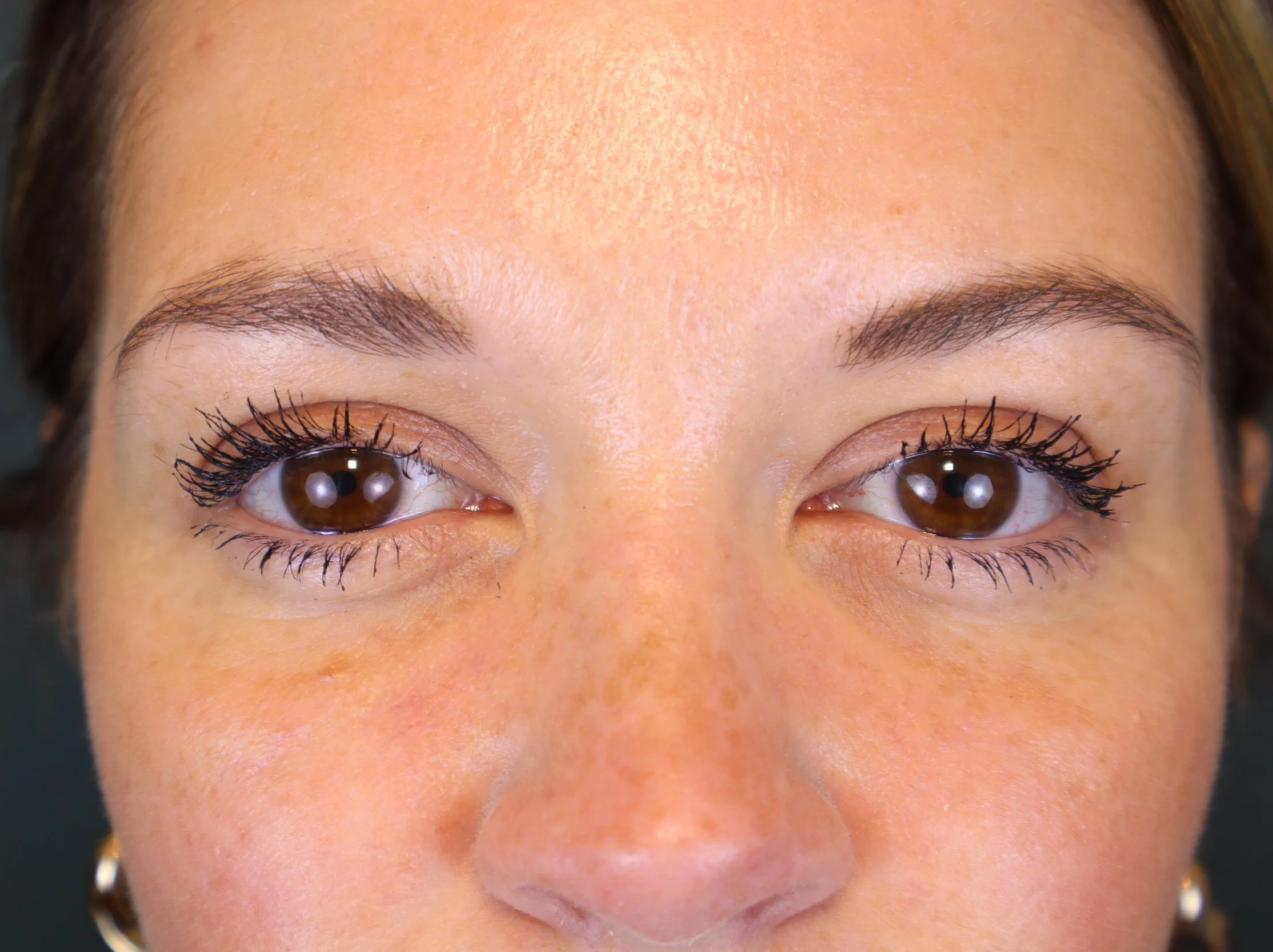 Upper Blepharoplasty 