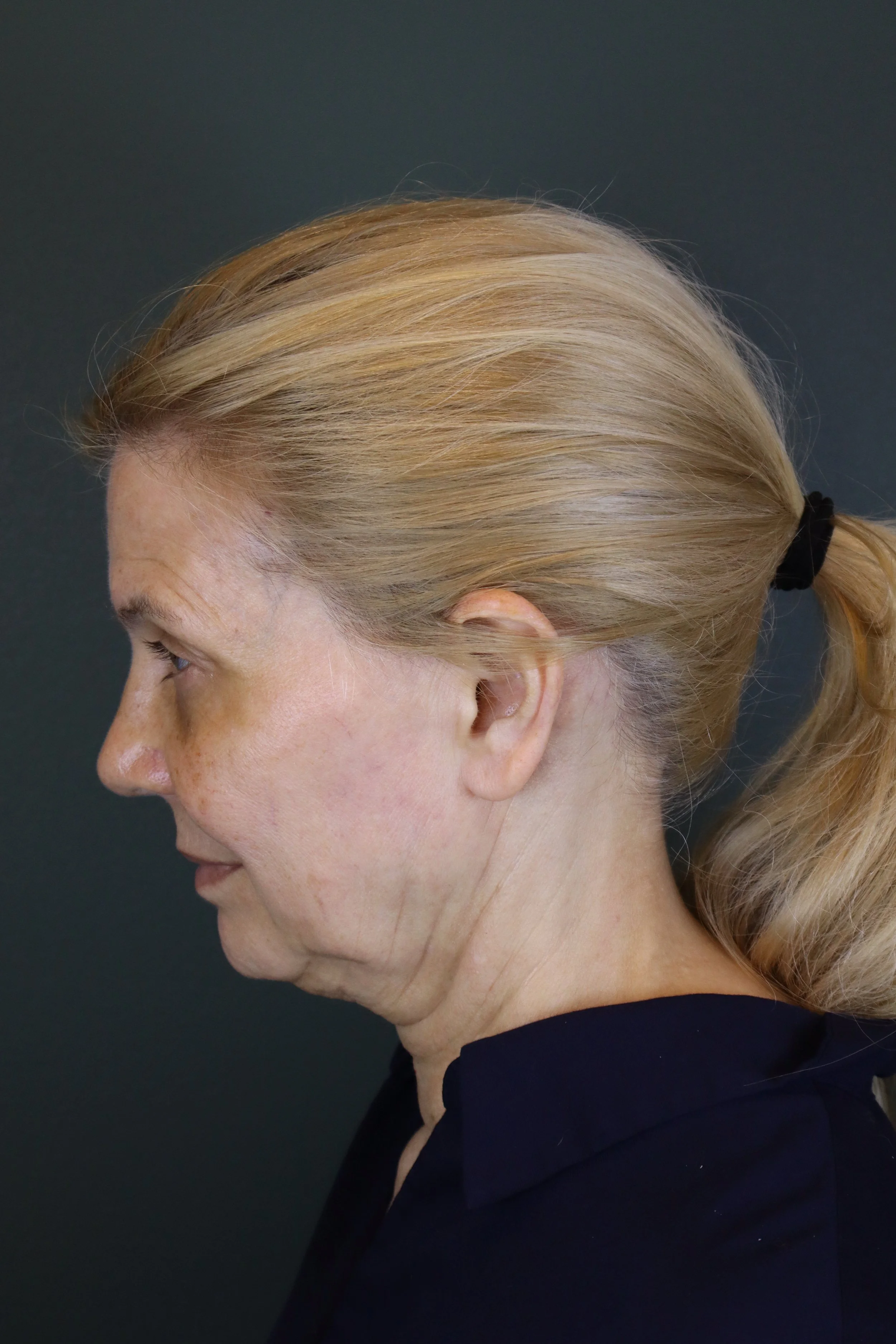 Deep Plane Face and Neck Lift 