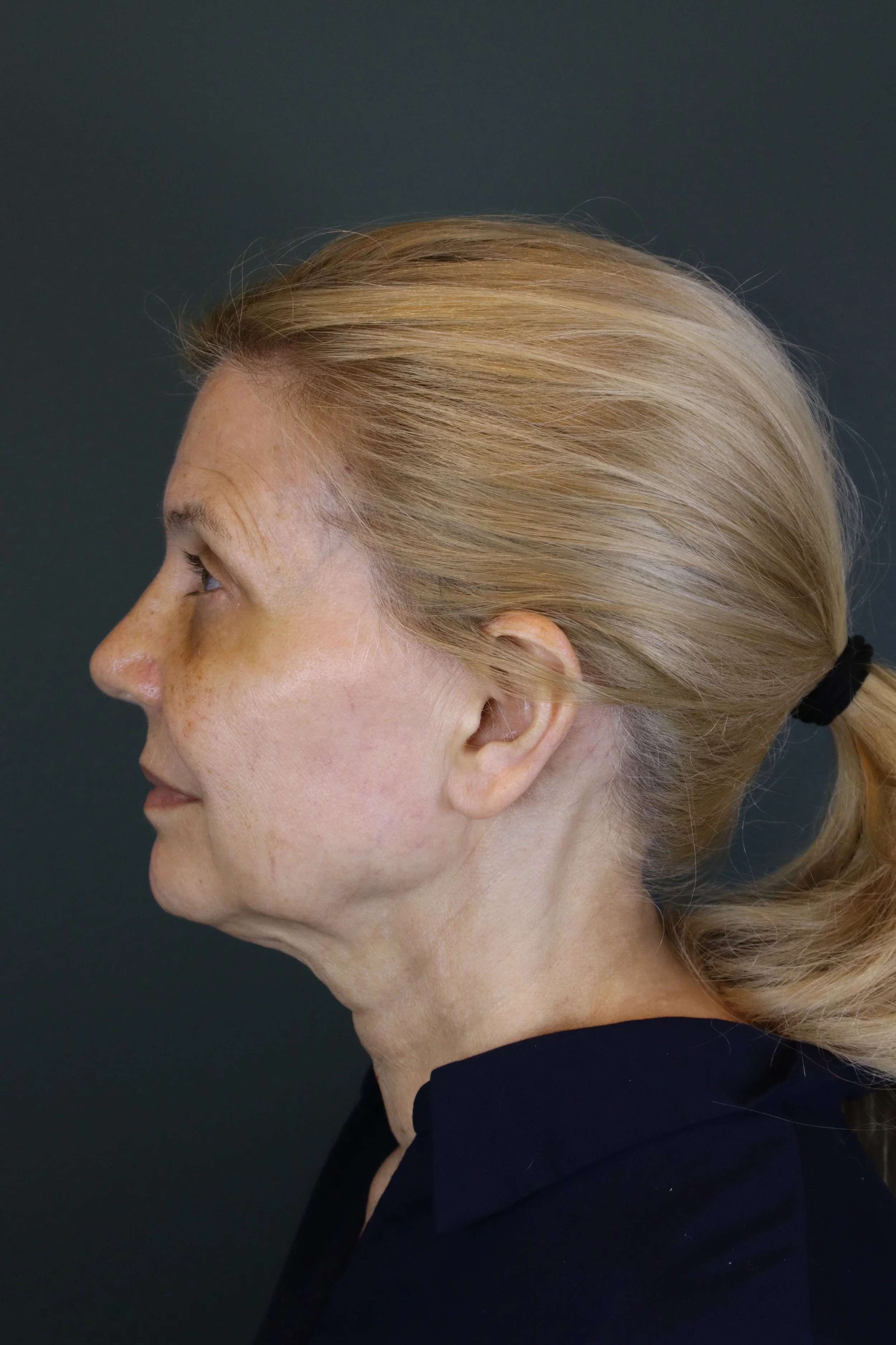 Deep Plane Face and Neck Lift 