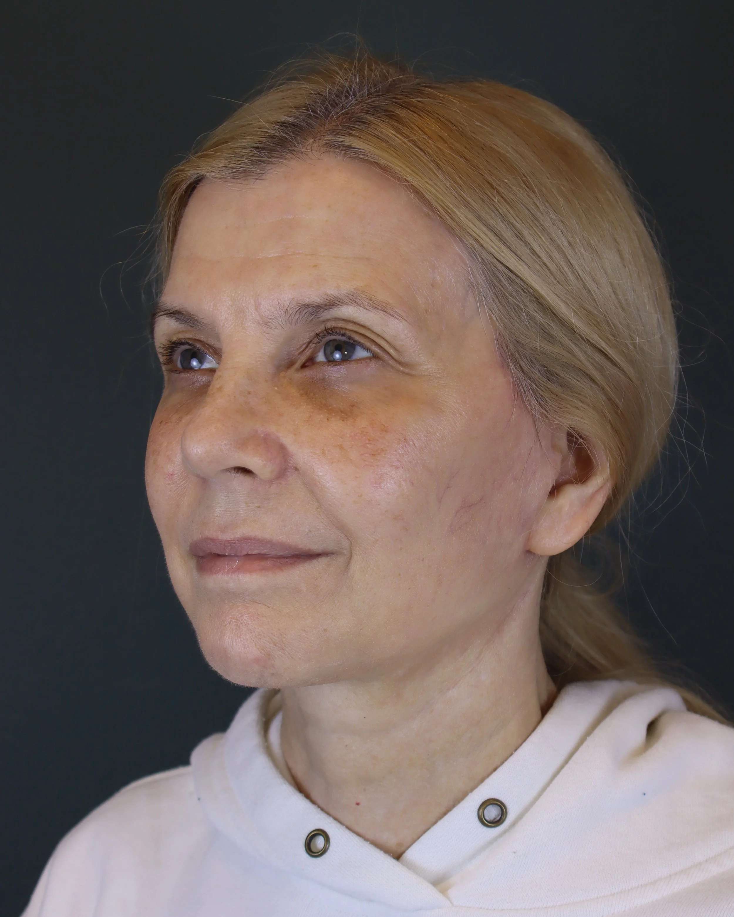 Deep Plane Face and Neck Lift 