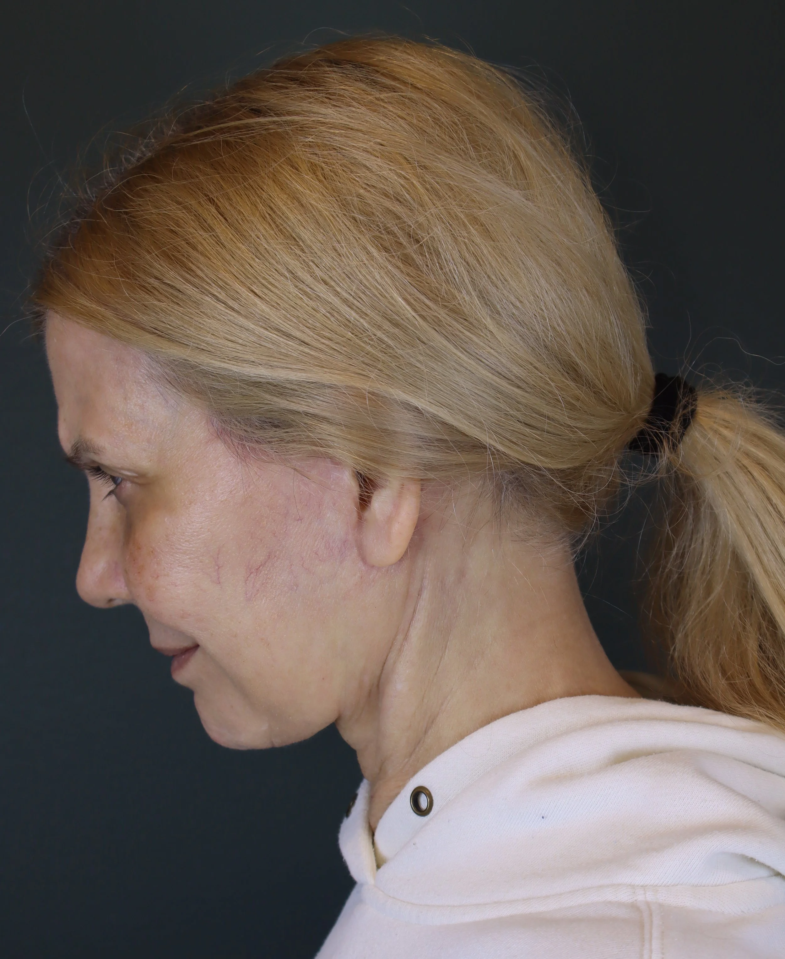 Deep Plane Face and Neck Lift 