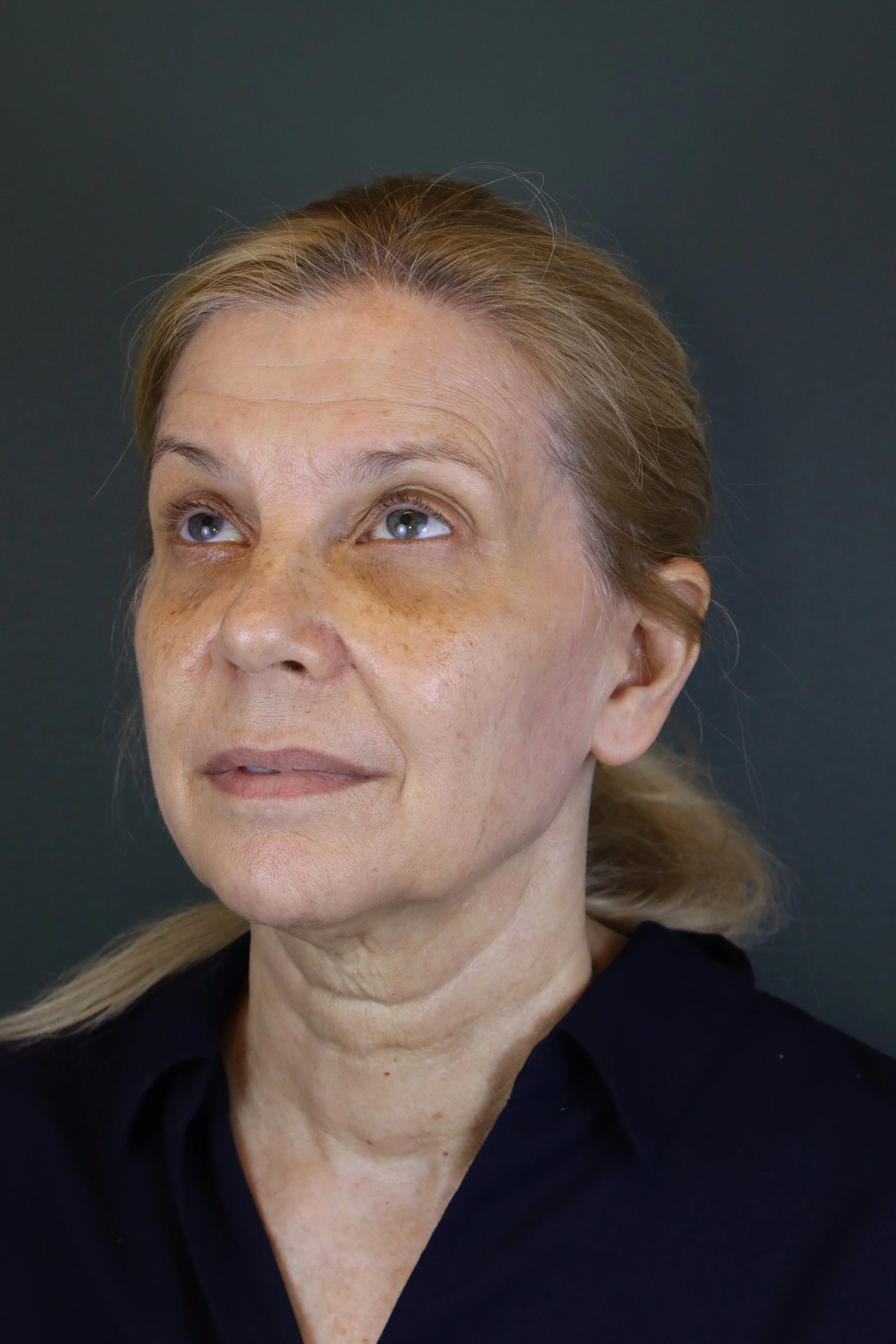 Deep Plane Face and Neck Lift 