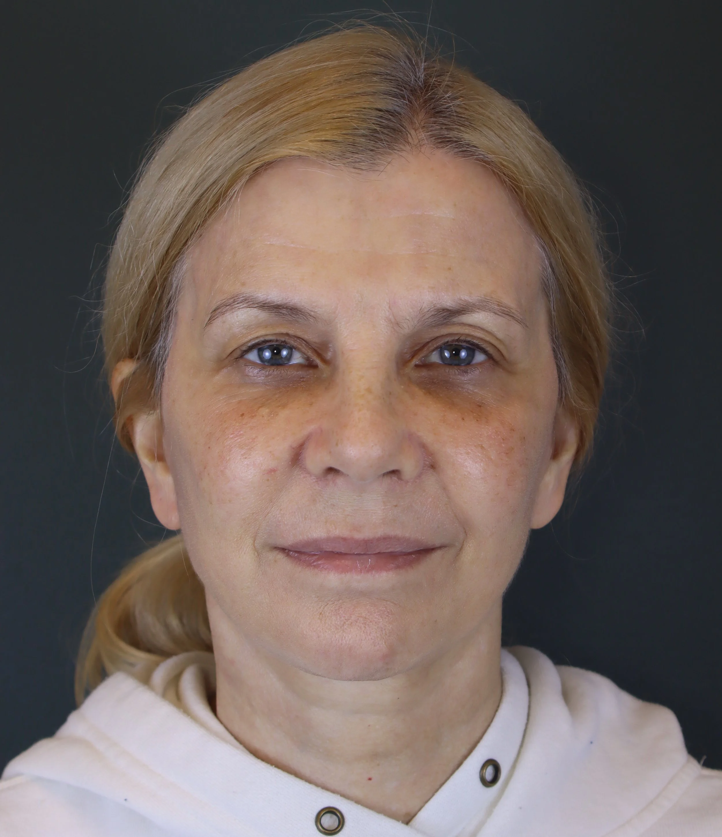 Deep Plane Face and Neck Lift 