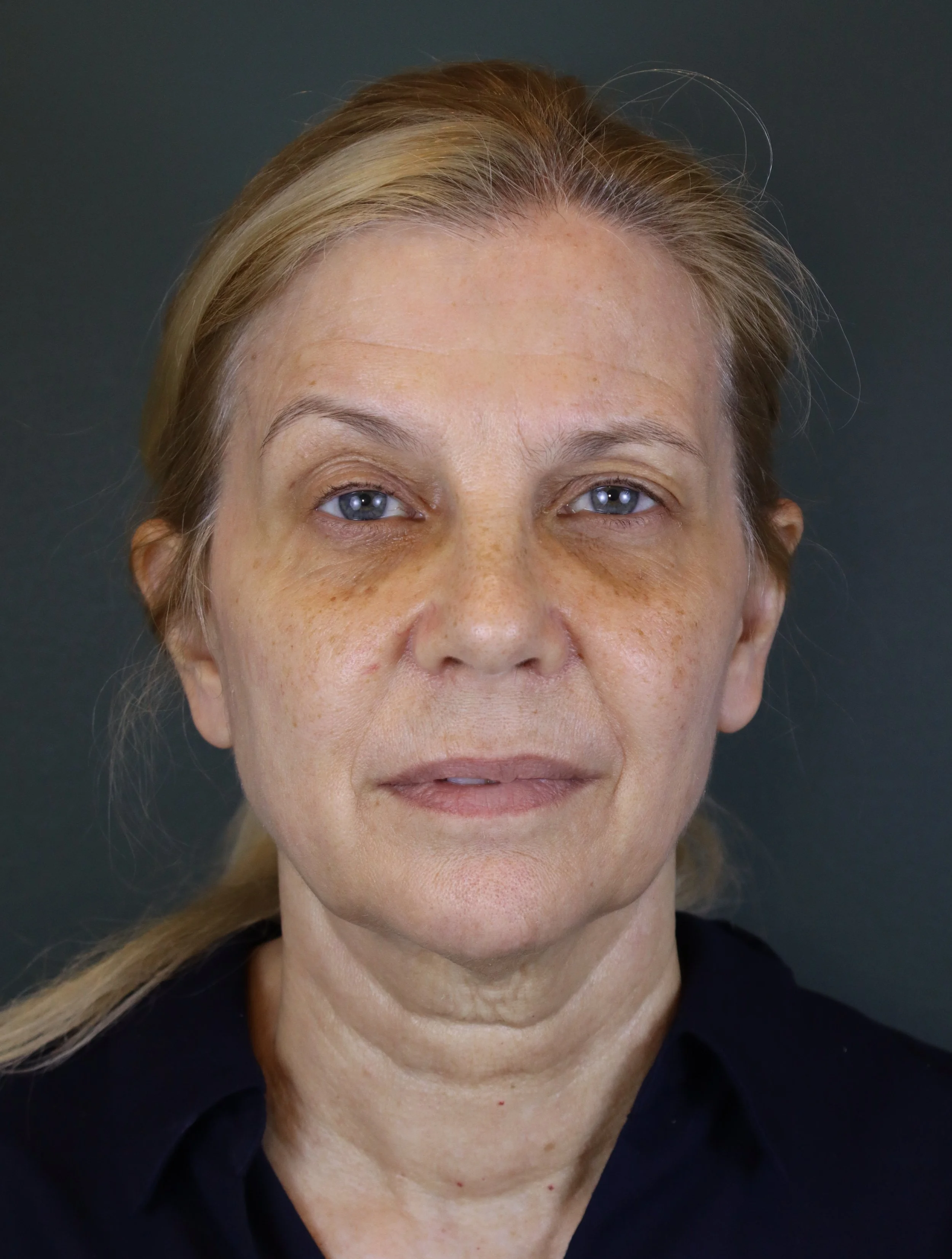 Deep Plane Face and Neck Lift 