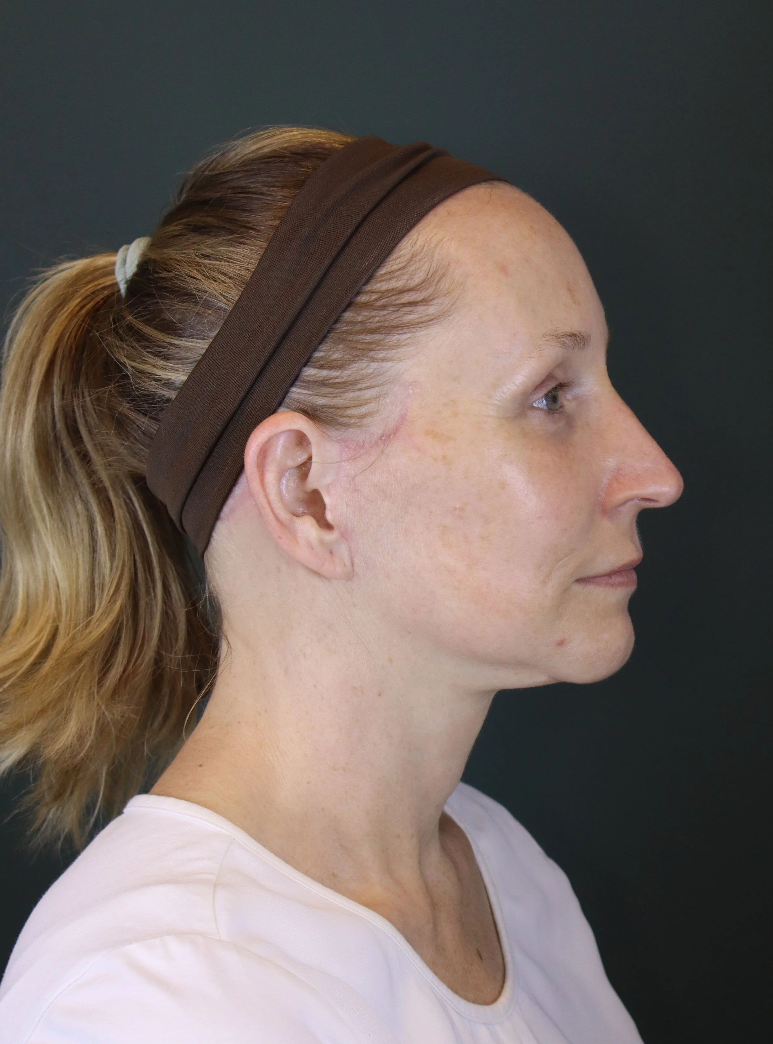 Deep Plane Face and Neck Lift 