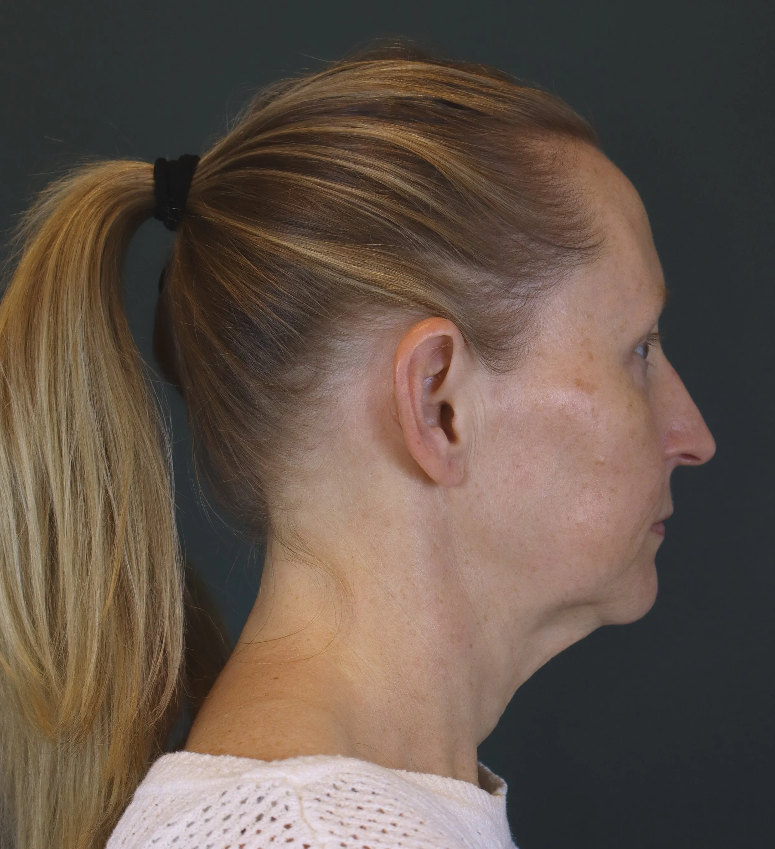 Deep Plane Face and Neck Lift 