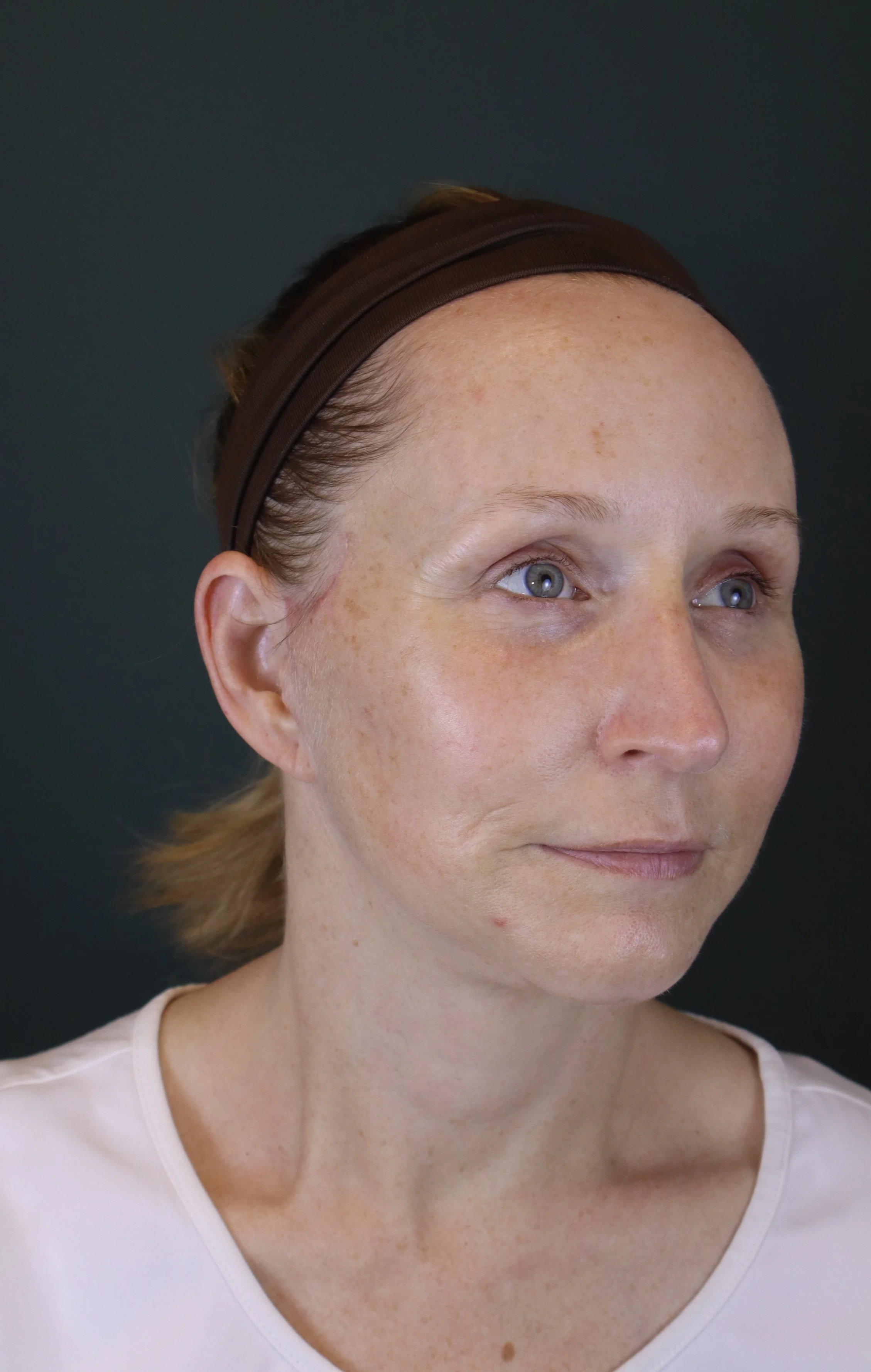 Deep Plane Face and Neck Lift 