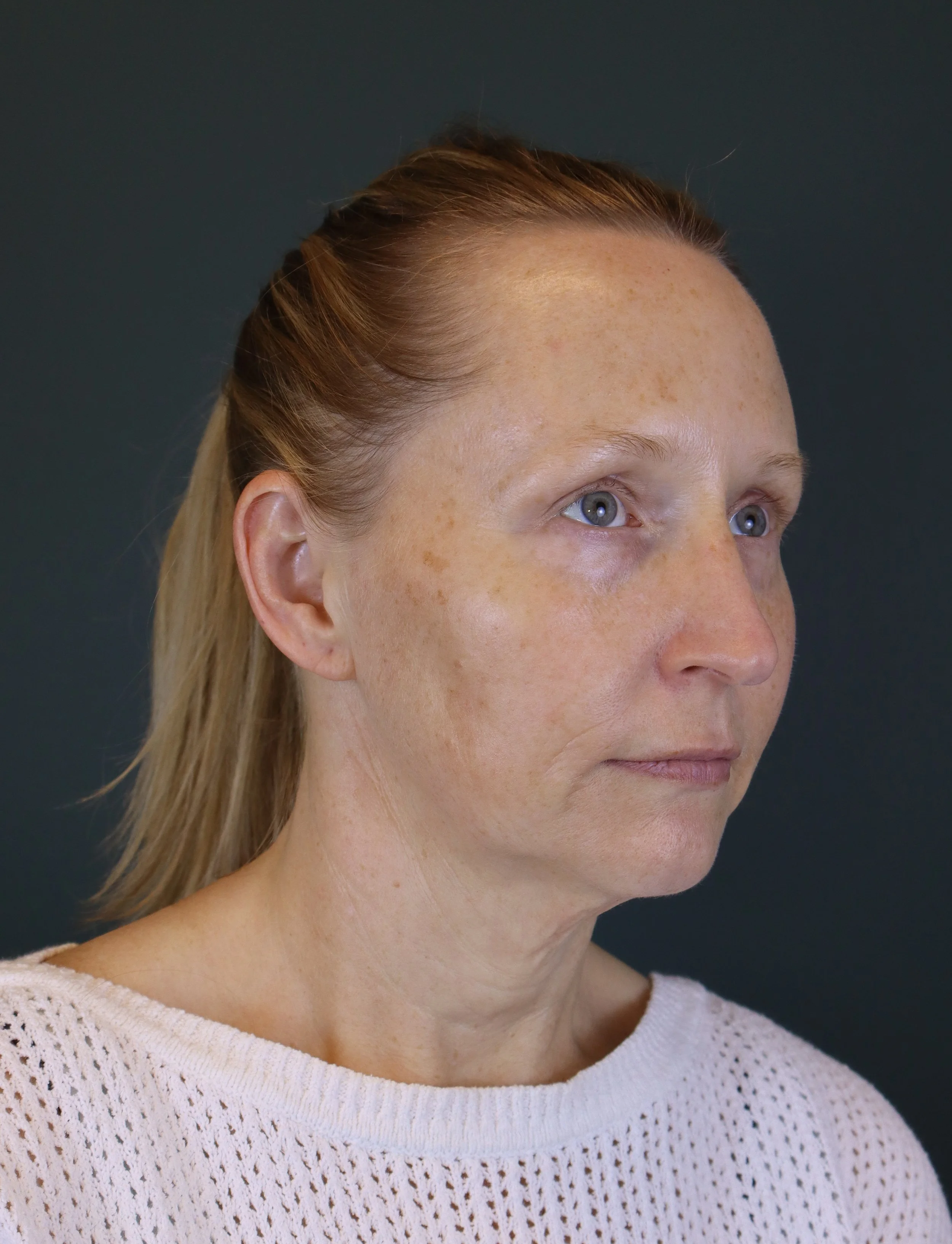 Deep Plane Face and Neck Lift