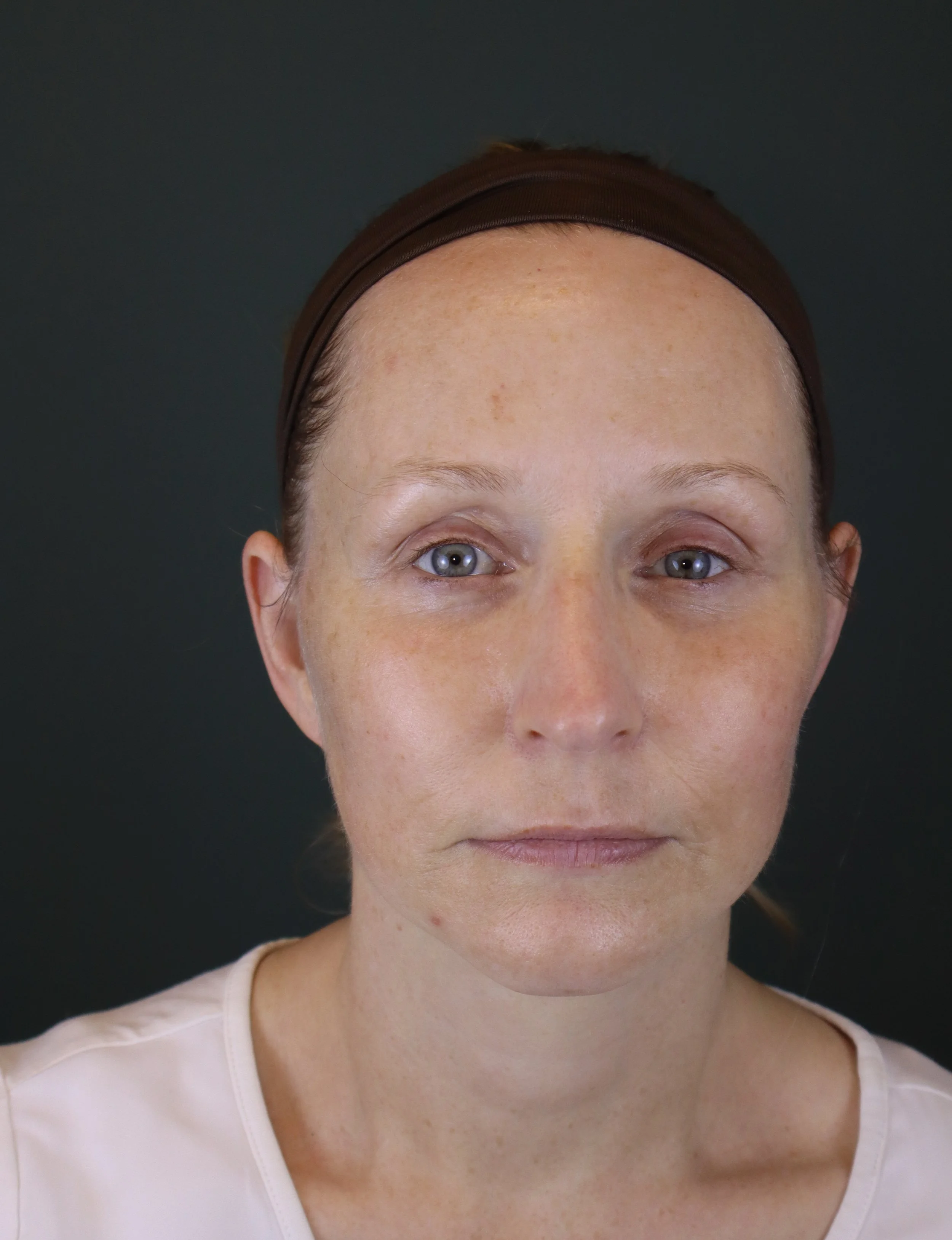Deep Plane Face and Neck Lift 