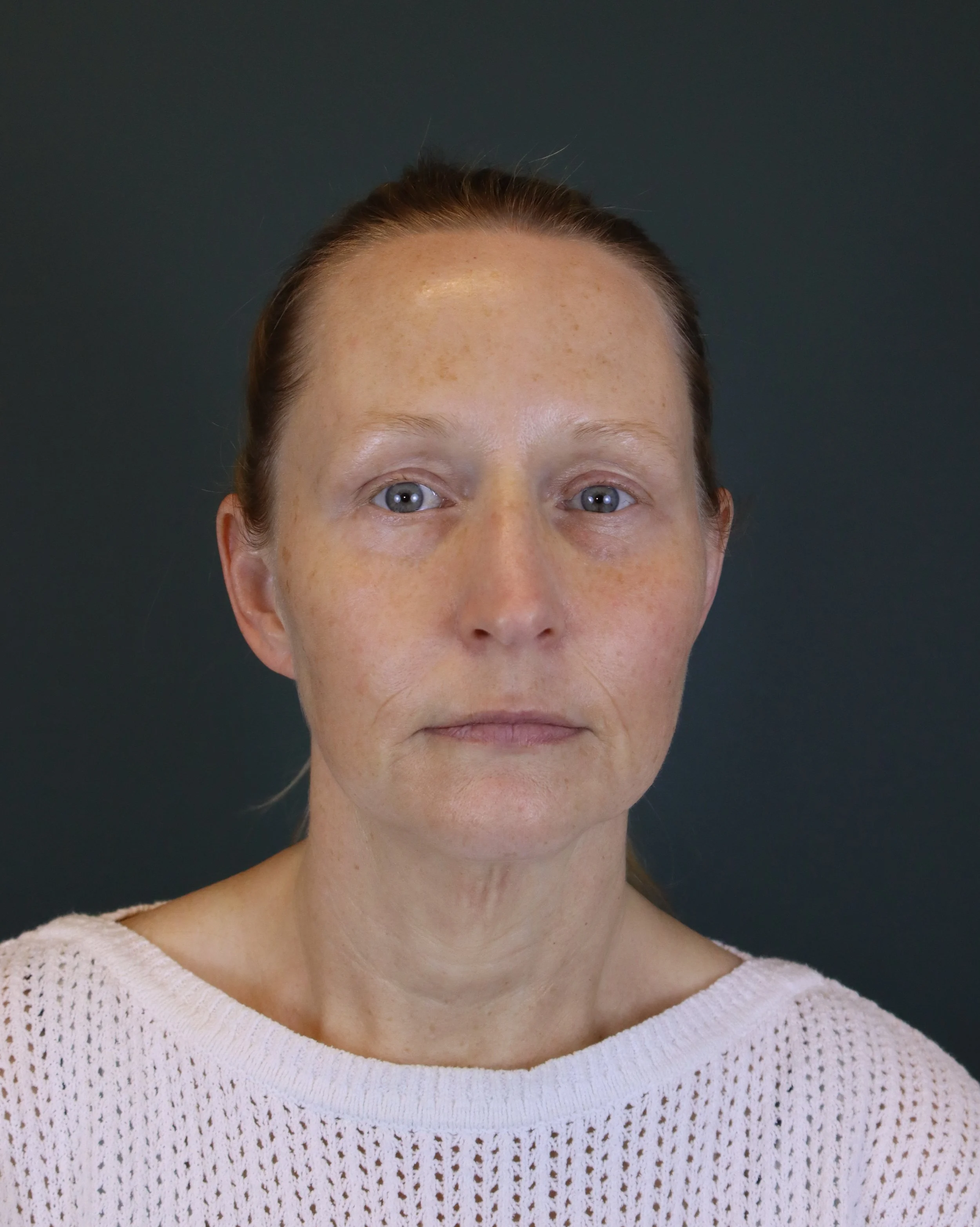 Deep Plane Face and Neck Lift 