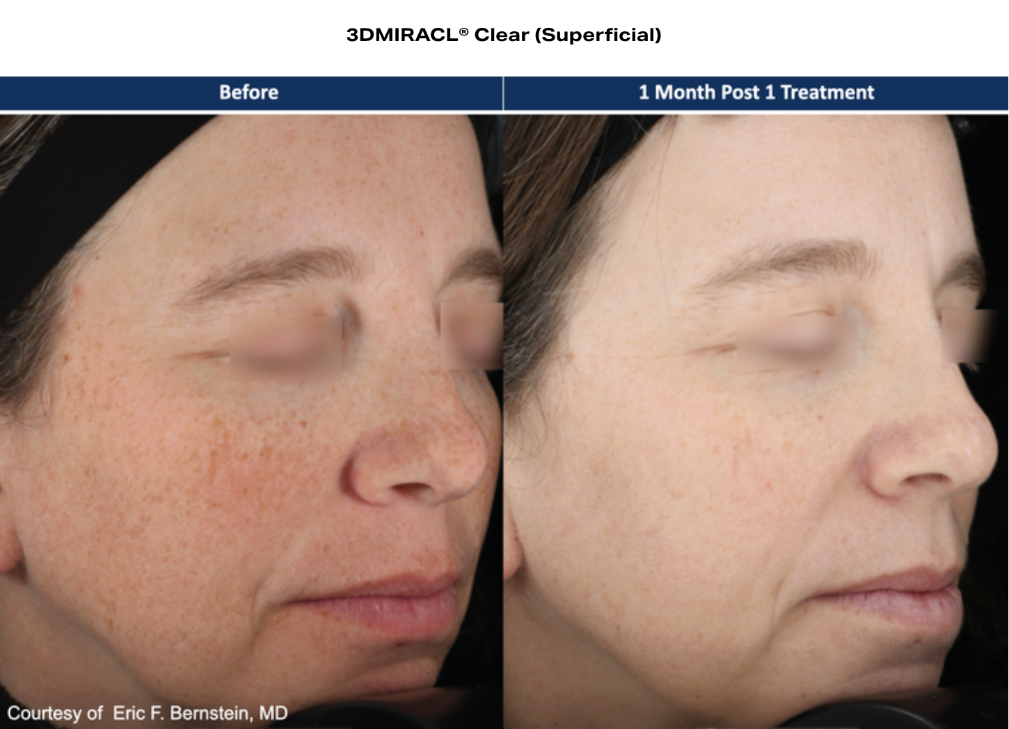 d3miracl clear before and after results