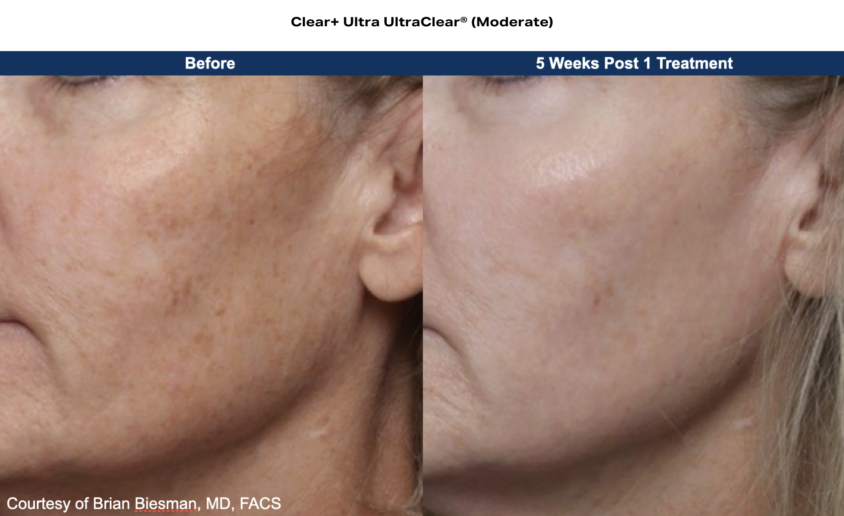 d3miracl clear+ before and after results